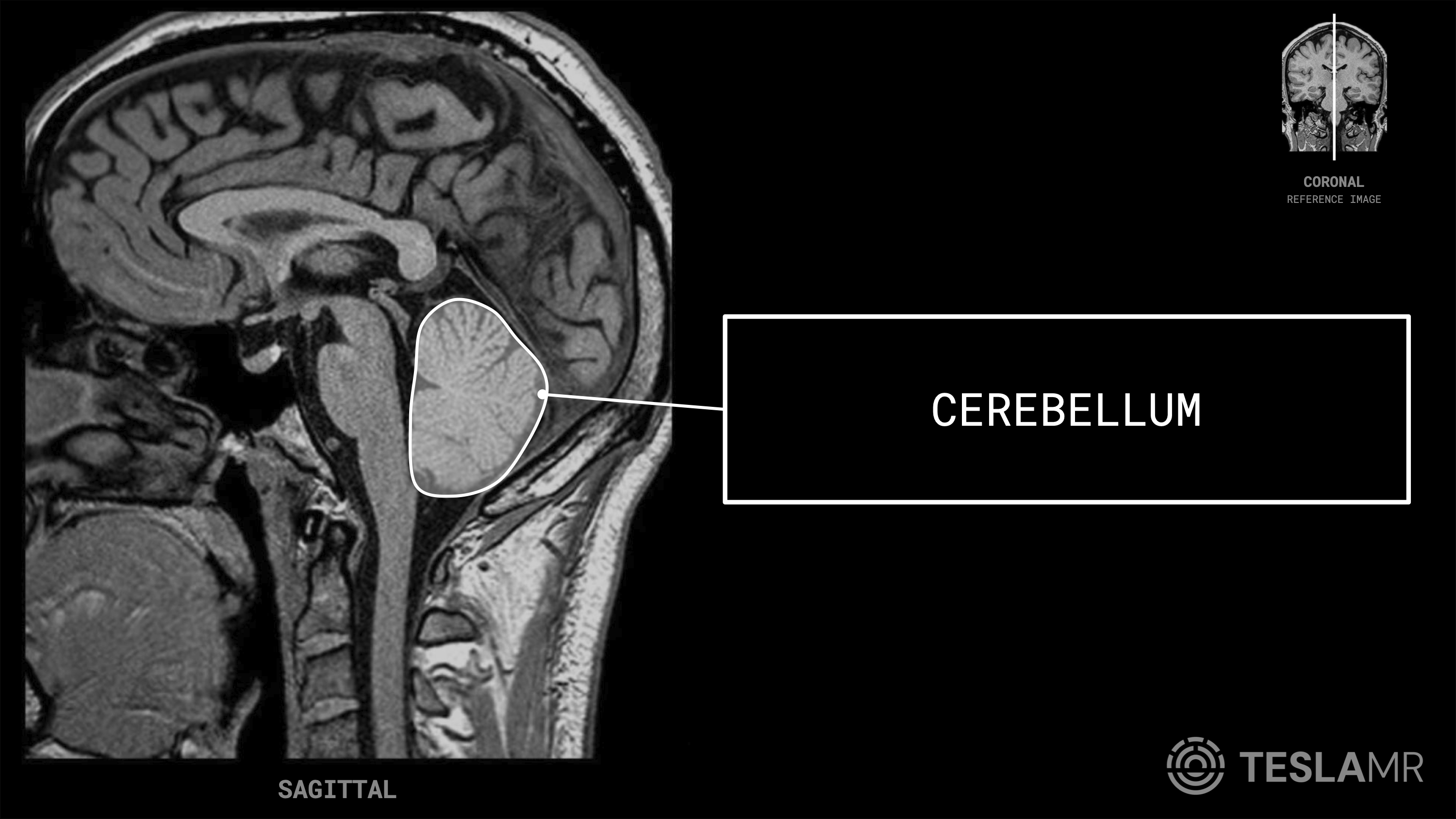 Cerebellum labeled on a Brain MRI (Sagittal · Axial)