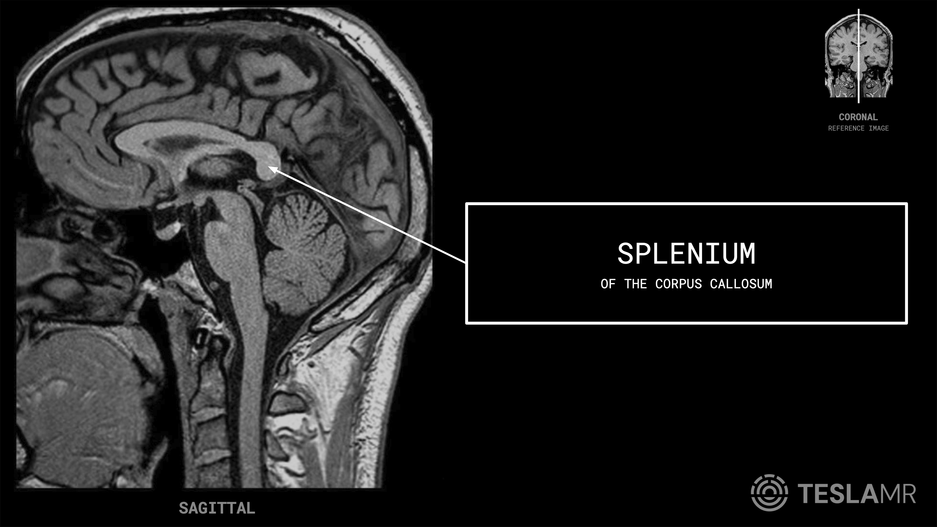 Splenium labeled on a Brain MRI (Sagittal)