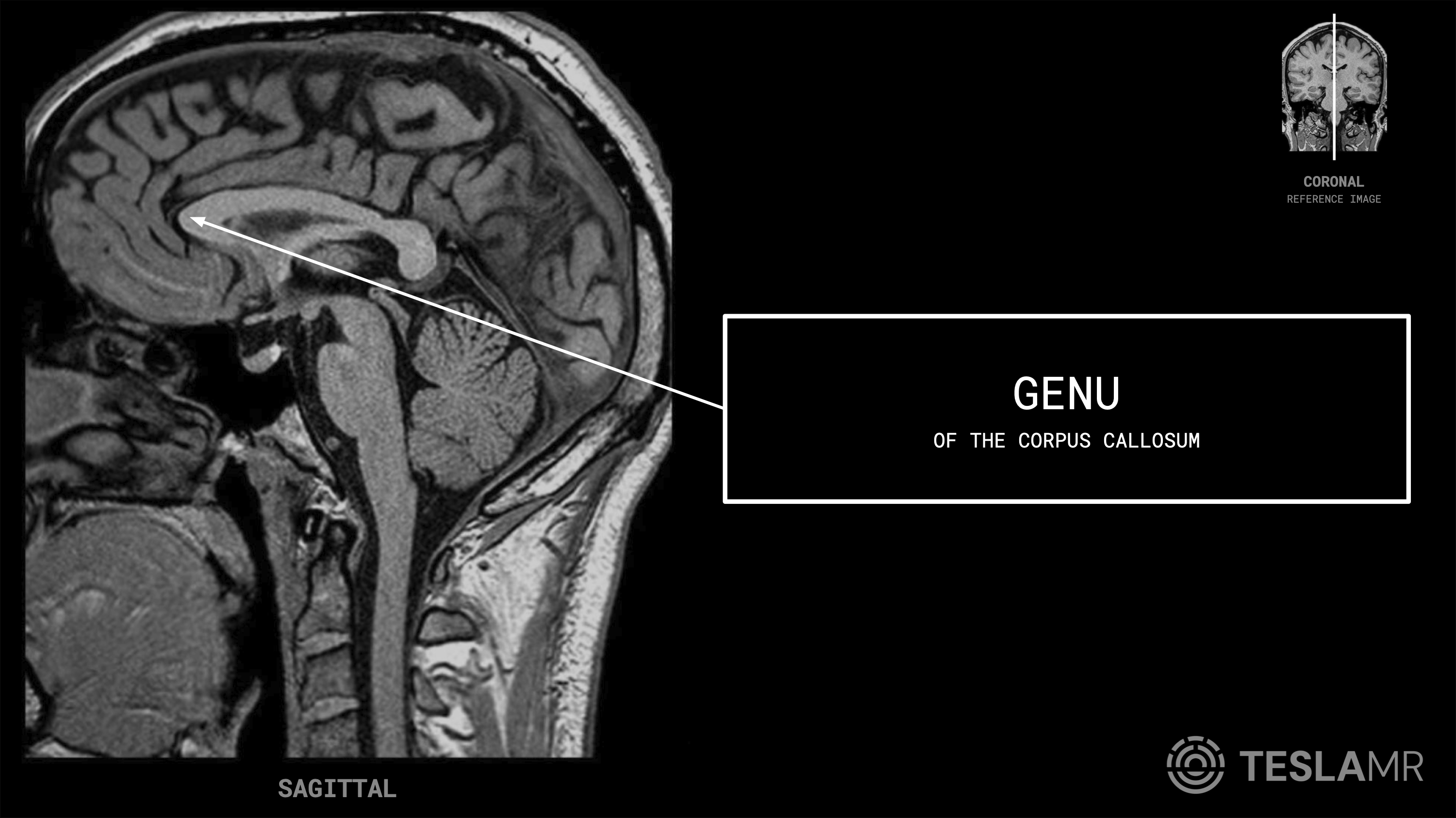 Genu labeled on a Brain MRI (Sagittal)