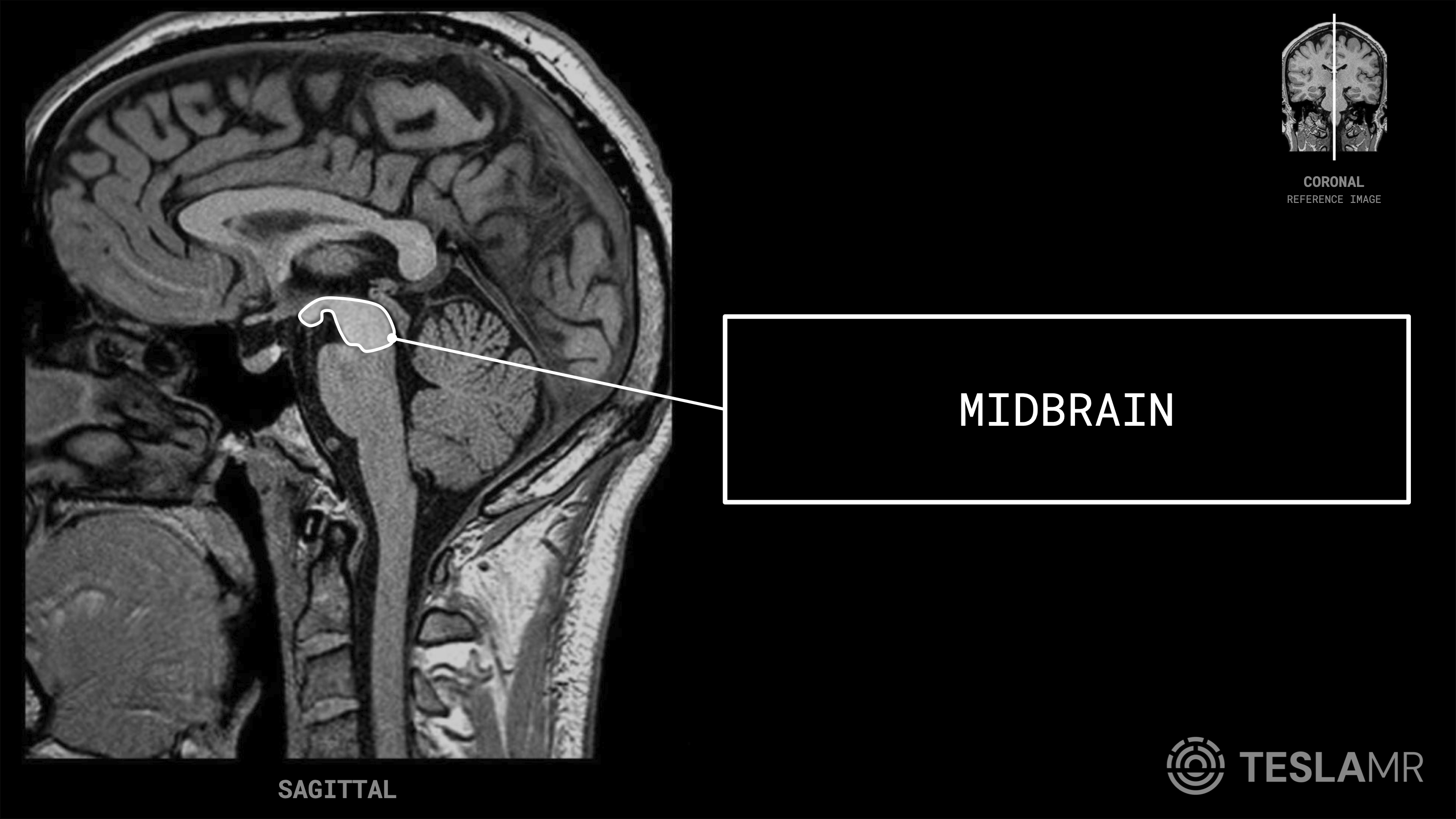 Midbrain labeled on a Brain MRI (Sagittal · Coronal)