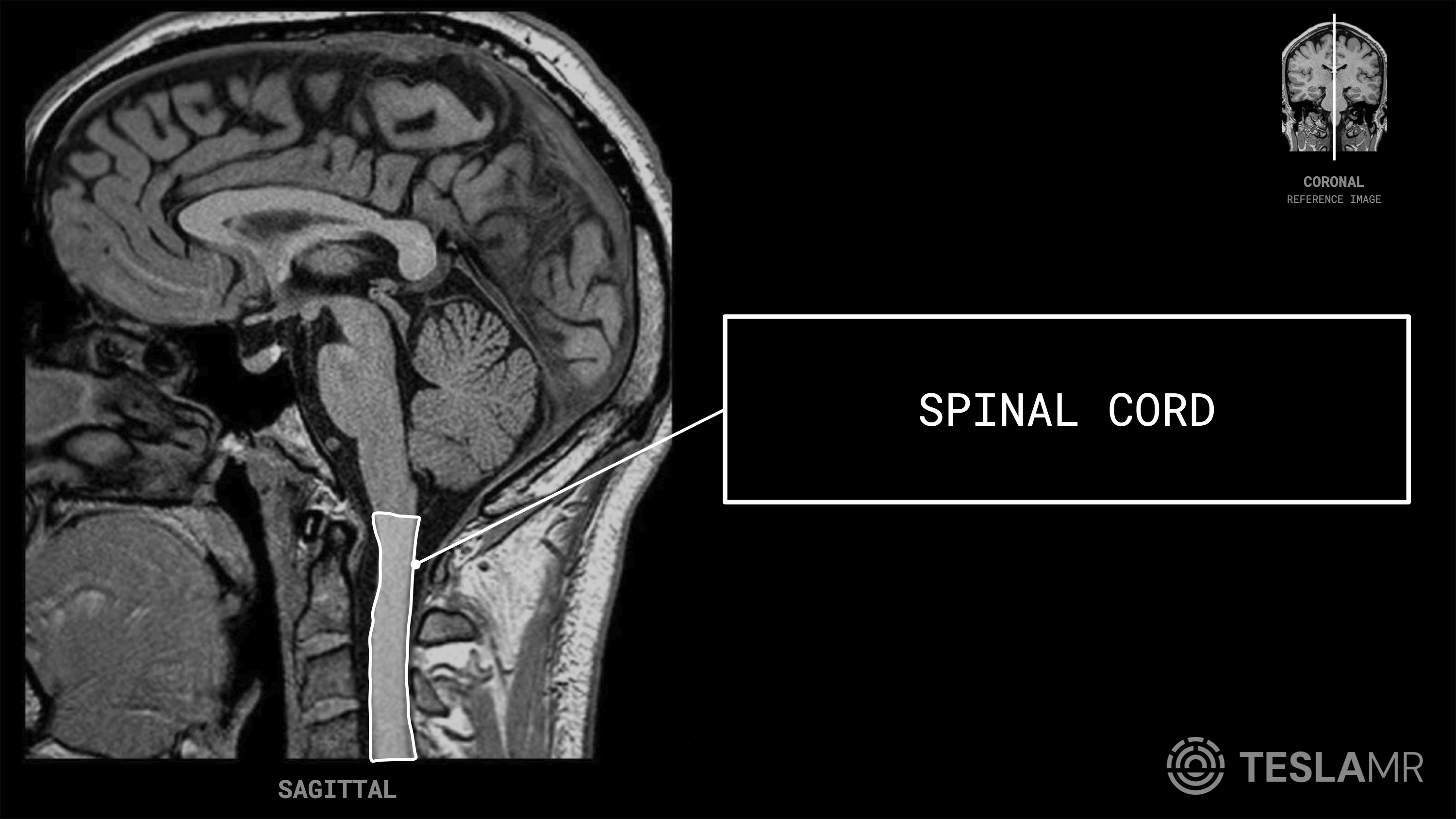Spinal Cord labeled on a Brain MRI (Sagittal)