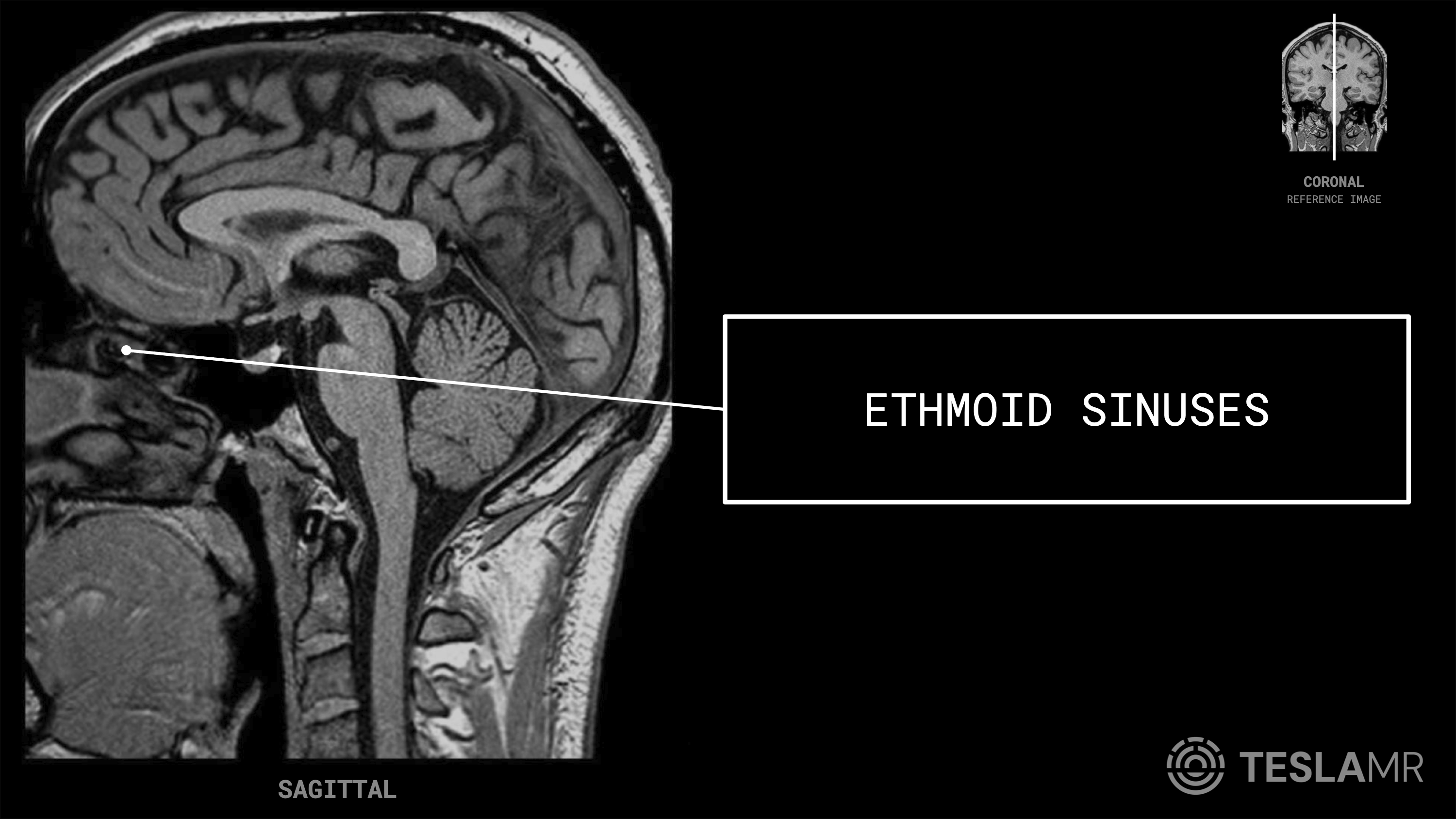 Ethmoid Sinuses labeled on a Brain MRI (Sagittal)