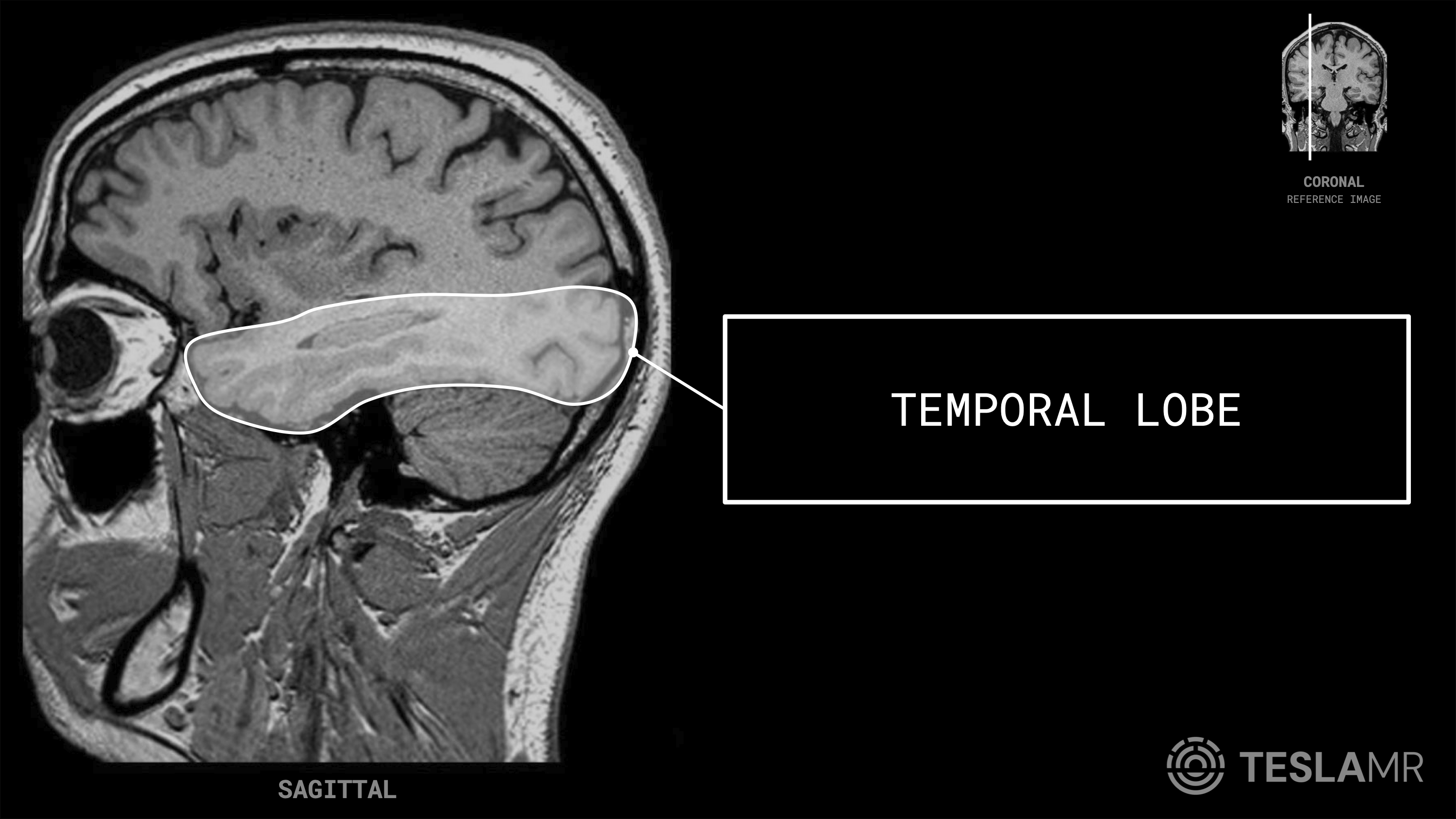 Temporal Lobe labeled on a Brain MRI (Sagittal · Coronal)