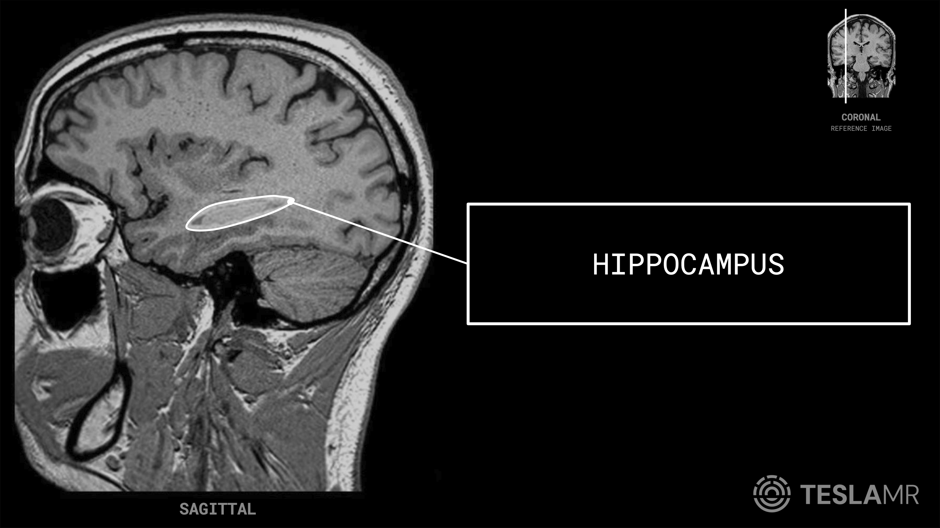 Hippocampus labeled on a Brain MRI (Sagittal · Coronal)
