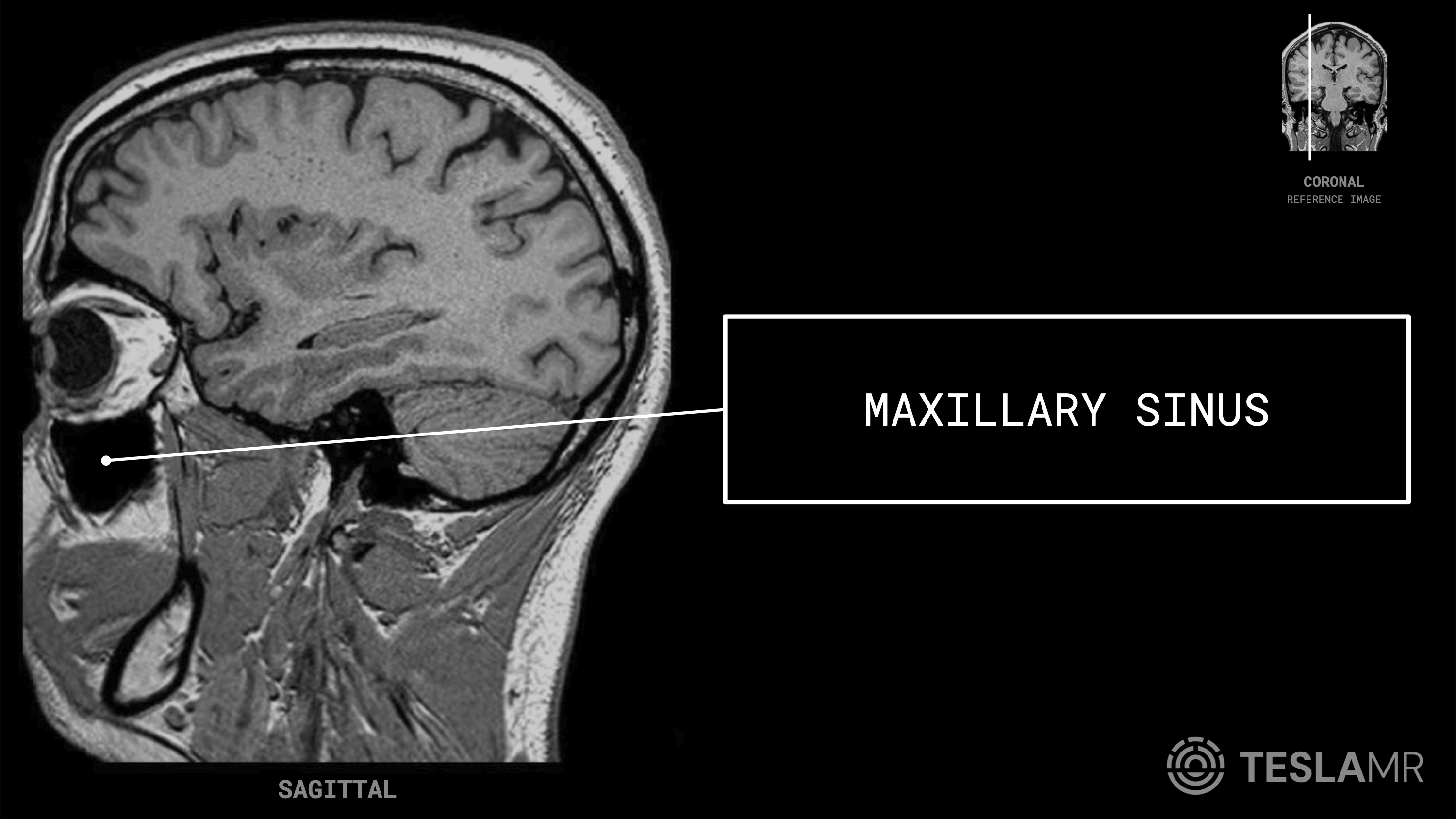 Maxillary Sinus labeled on a Brain MRI (Sagittal)