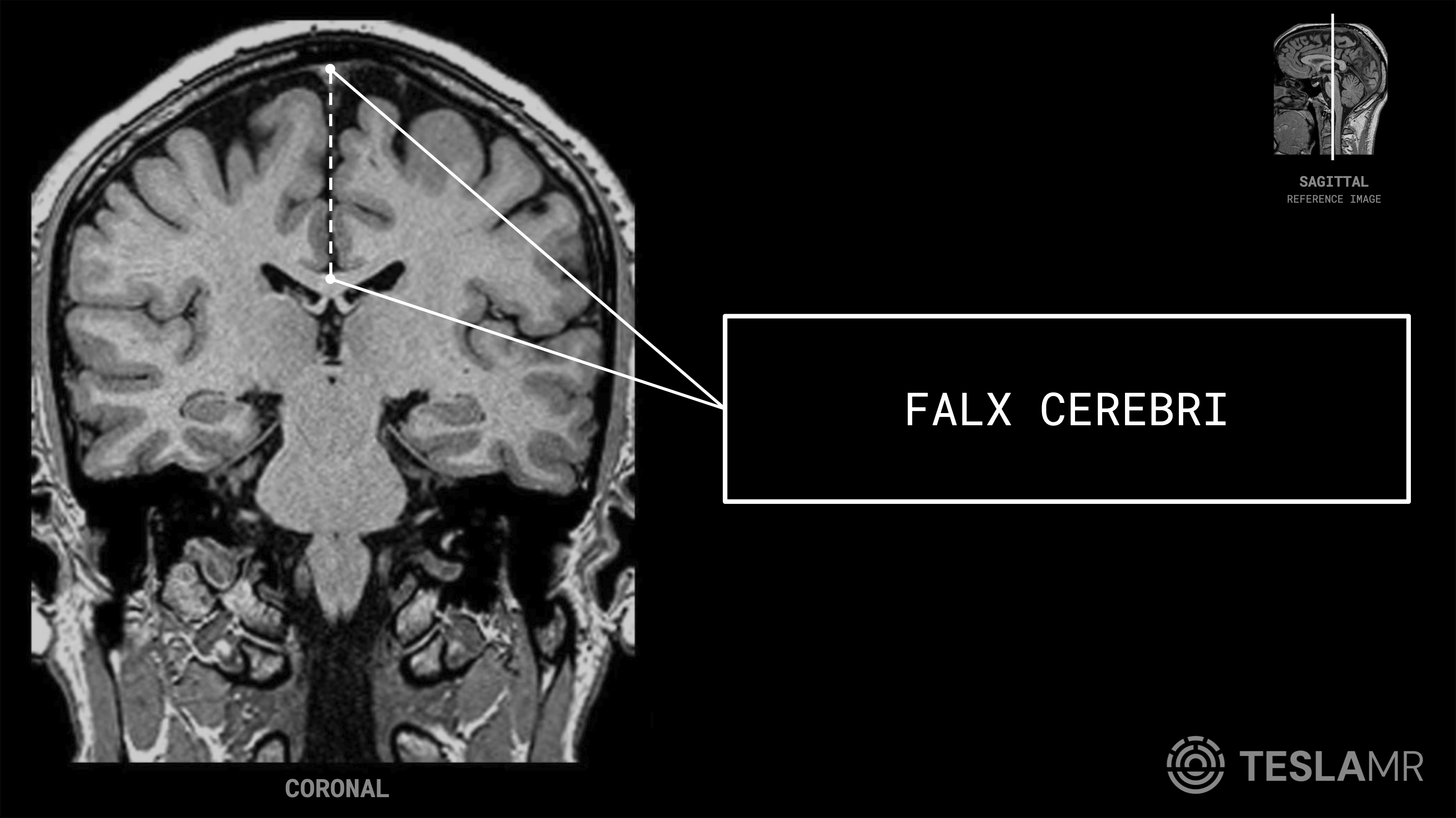 Falx Cerebri labeled on a Brain MRI (Coronal)