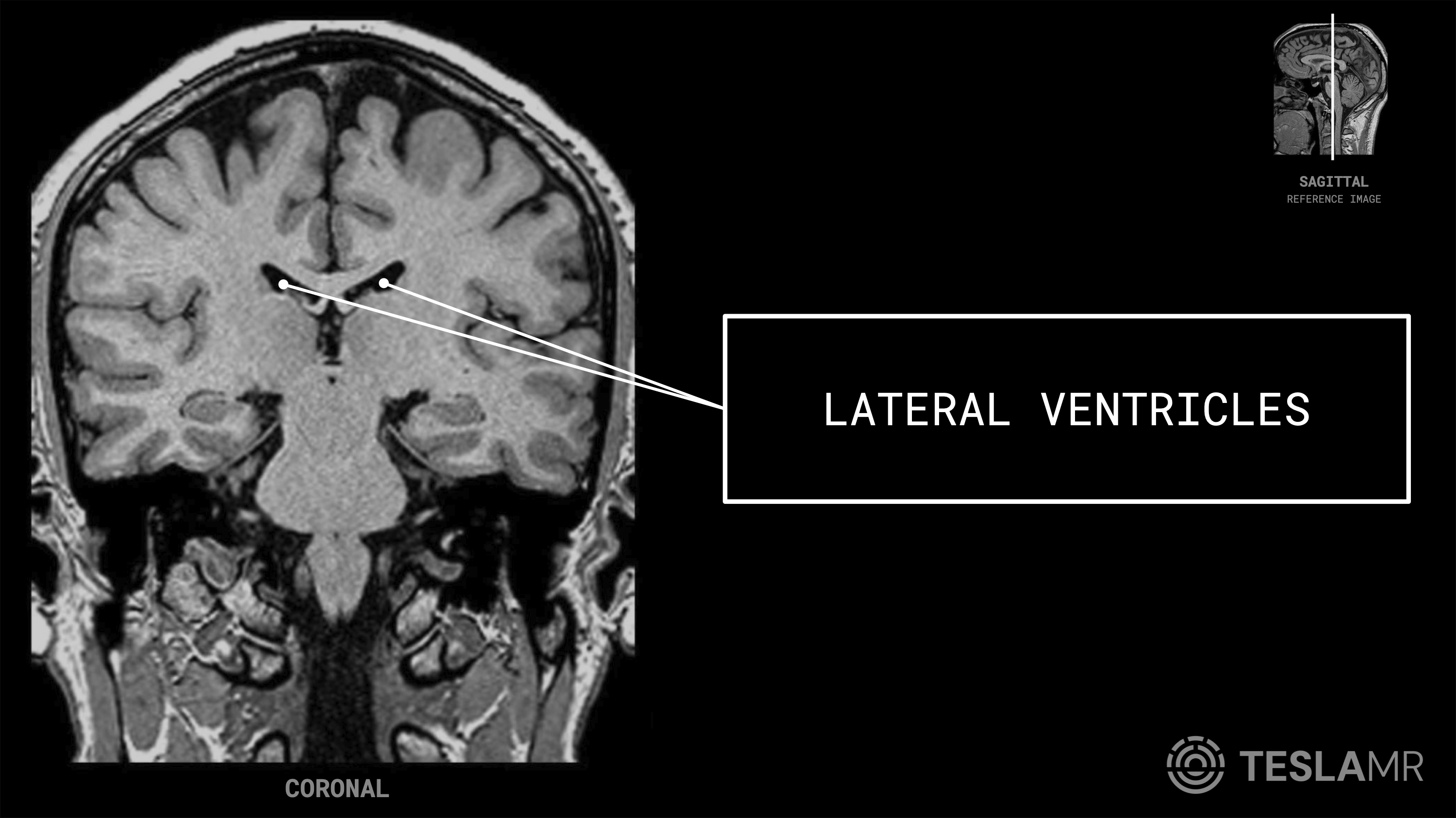 Lateral Ventricles labeled on a Brain MRI (Sagittal · Coronal · Axial)