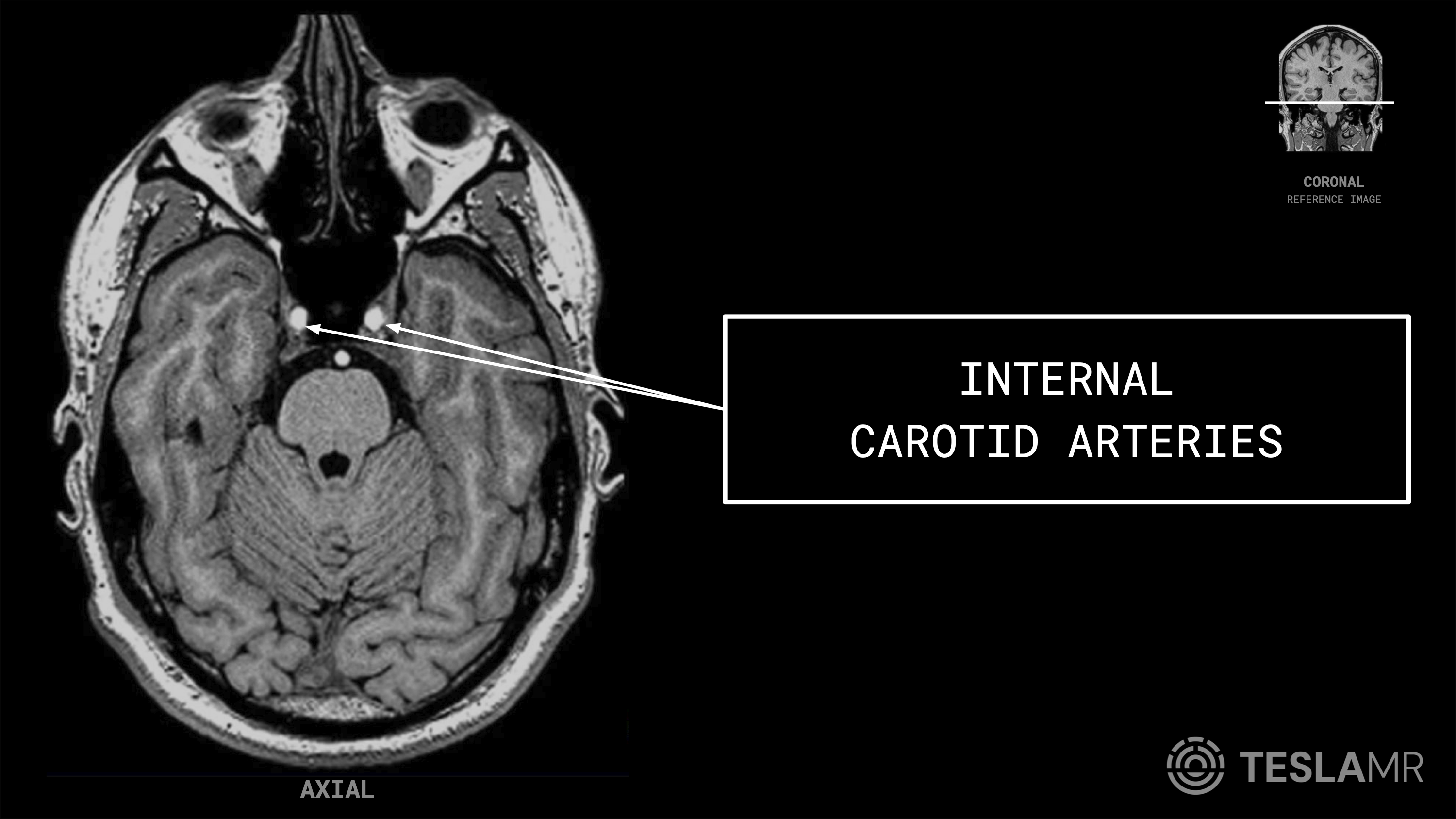 Internal Carotid Arteries labeled on a Brain MRI (Axial)