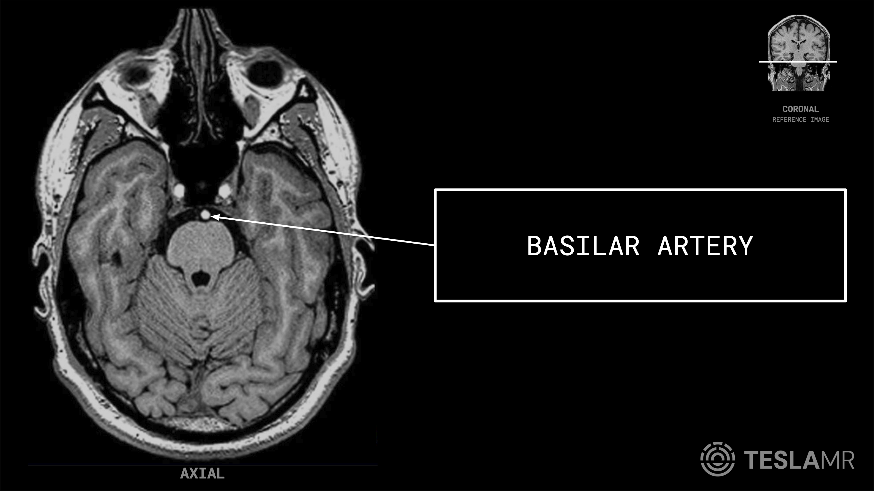 Basilar Artery labeled on a Brain MRI (Axial)