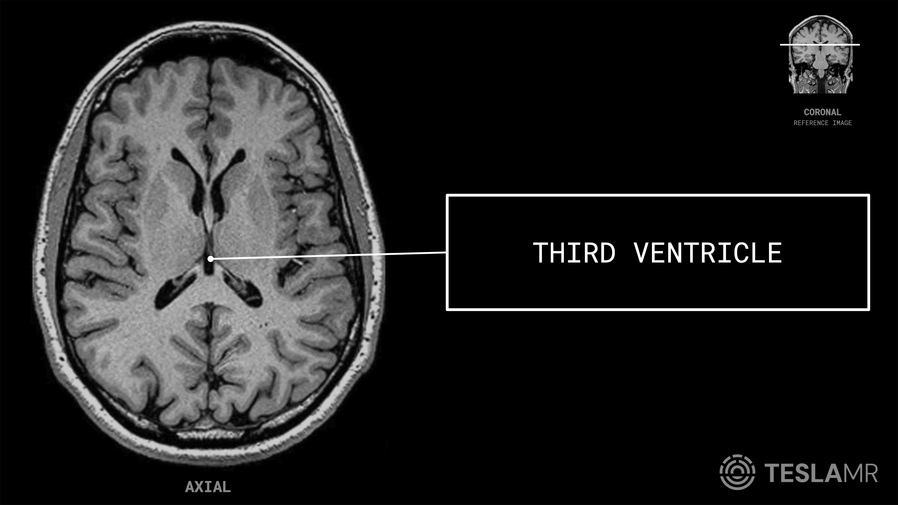 Third Ventricle labeled on a Brain MRI (Axial)