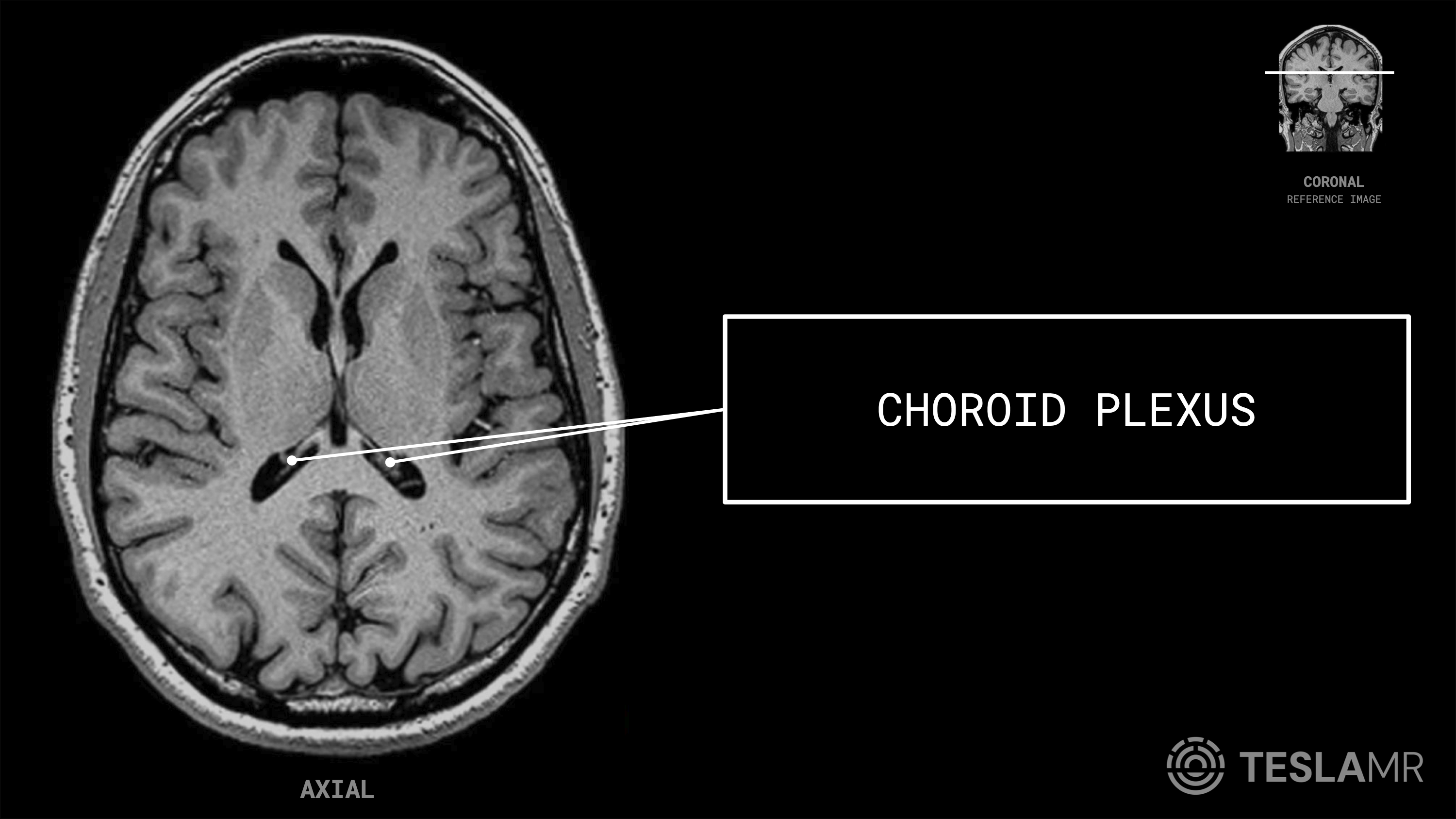 Choroid Plexus labeled on a Brain MRI (Axial)
