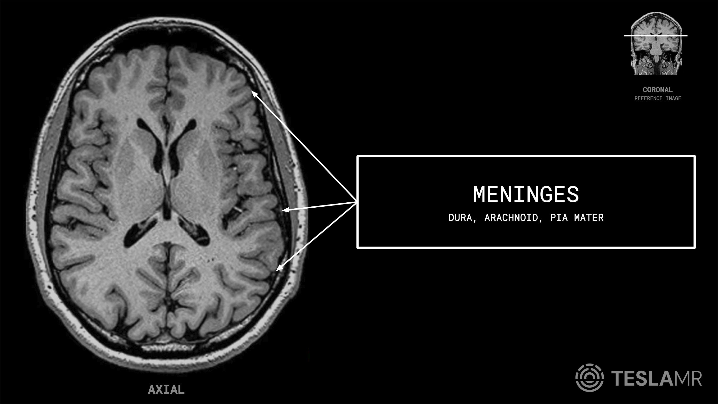 Meninges labeled on a Brain MRI (Axial)