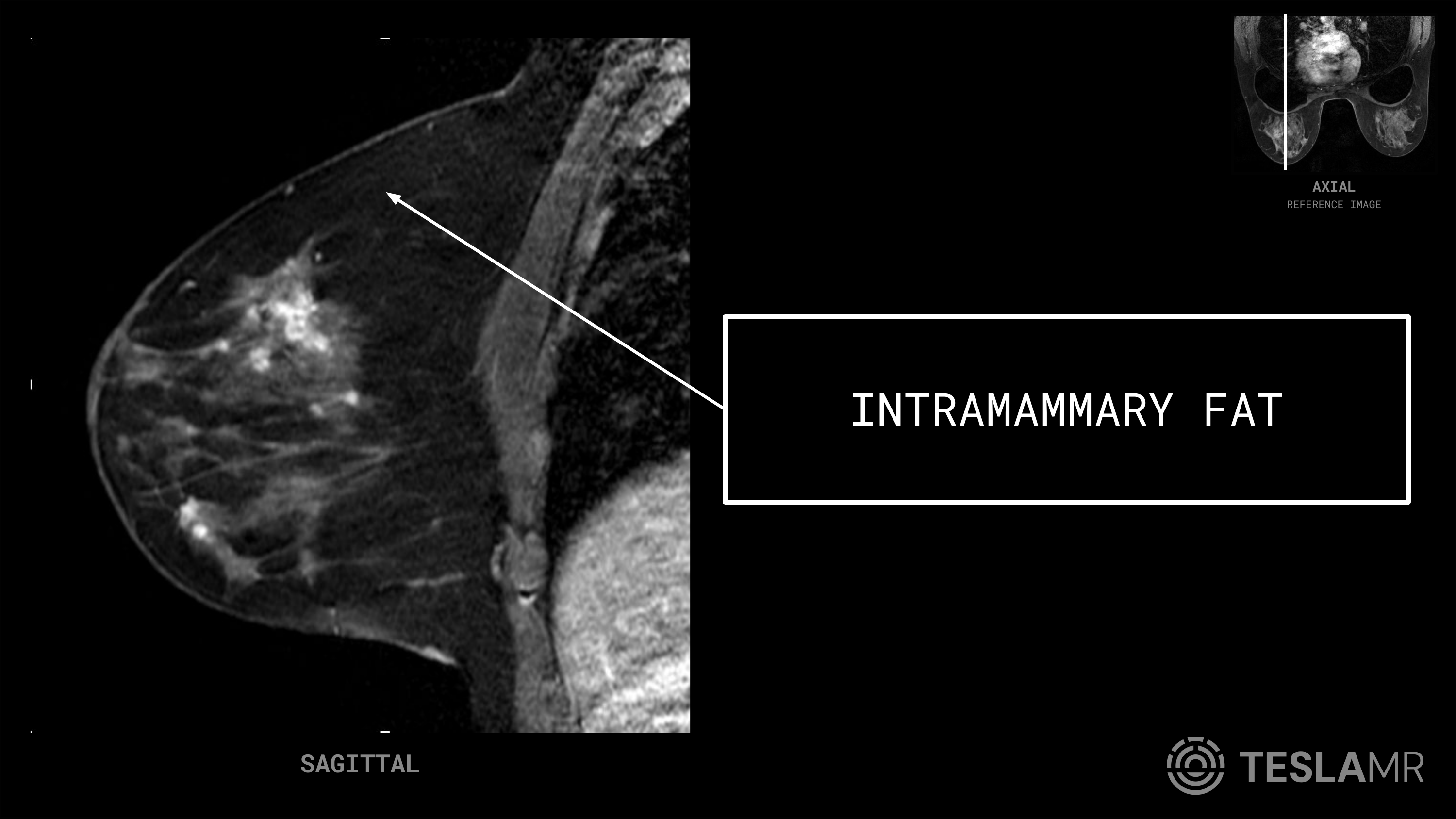 Intramammary Fat labeled on a Breast MRI (Sagittal)