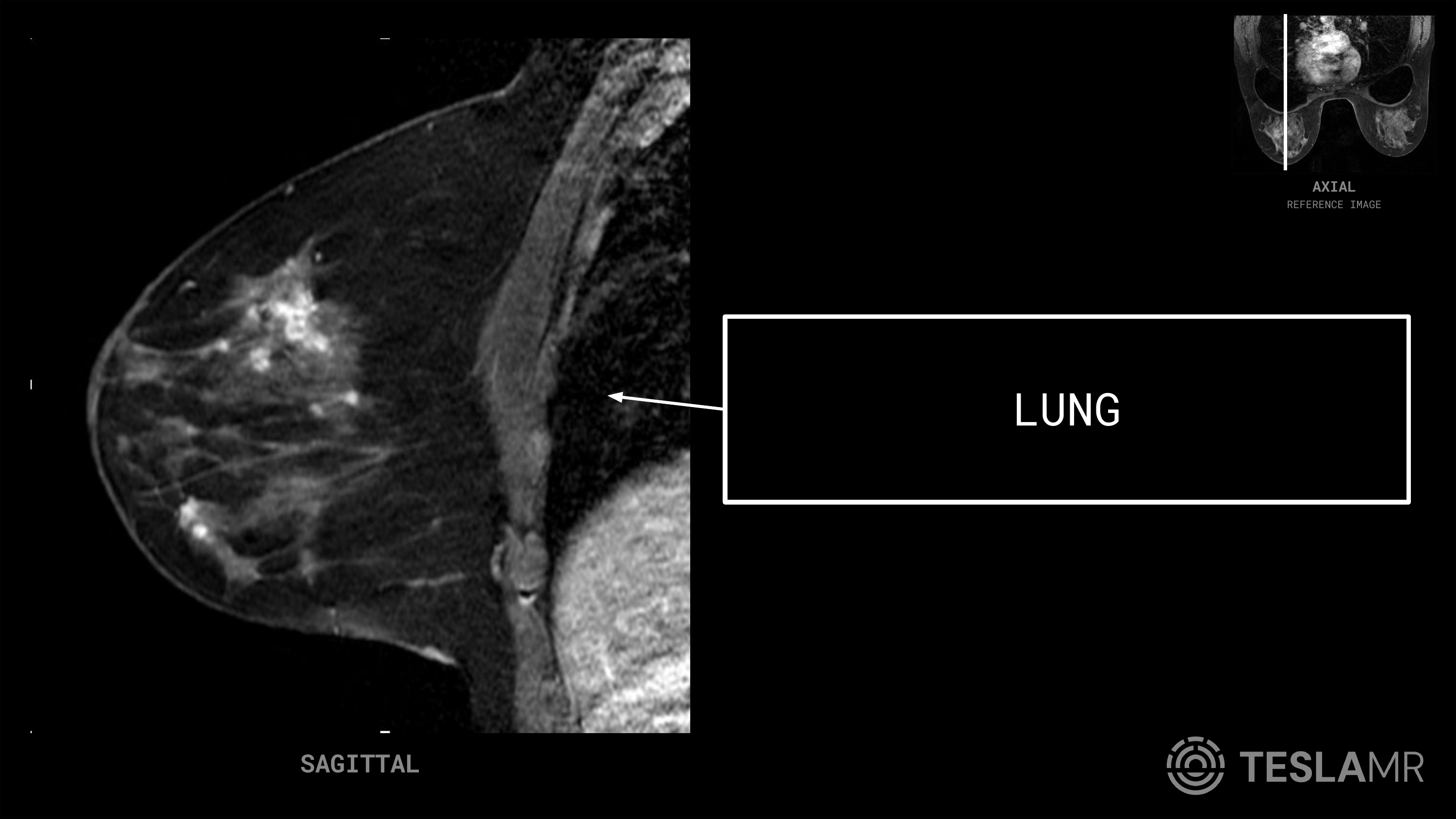 Lung labeled on a Breast MRI (Sagittal)