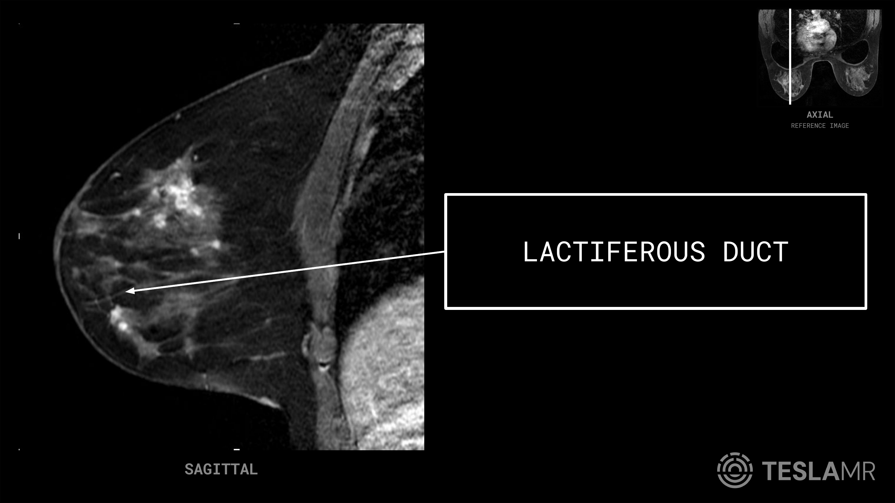 Lactiferous Duct labeled on a Breast MRI (Sagittal)