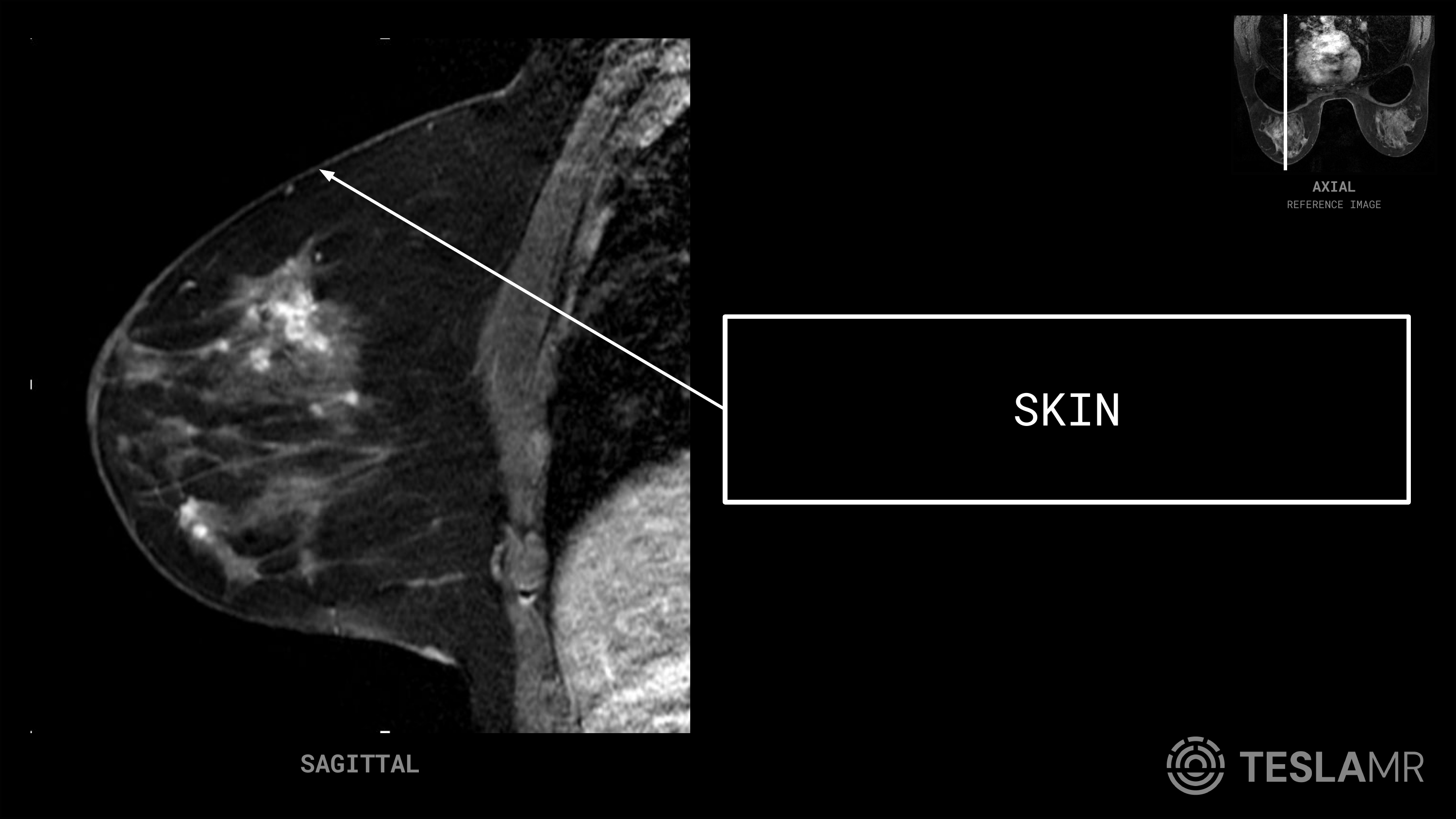 Skin labeled on a Breast MRI (Sagittal)