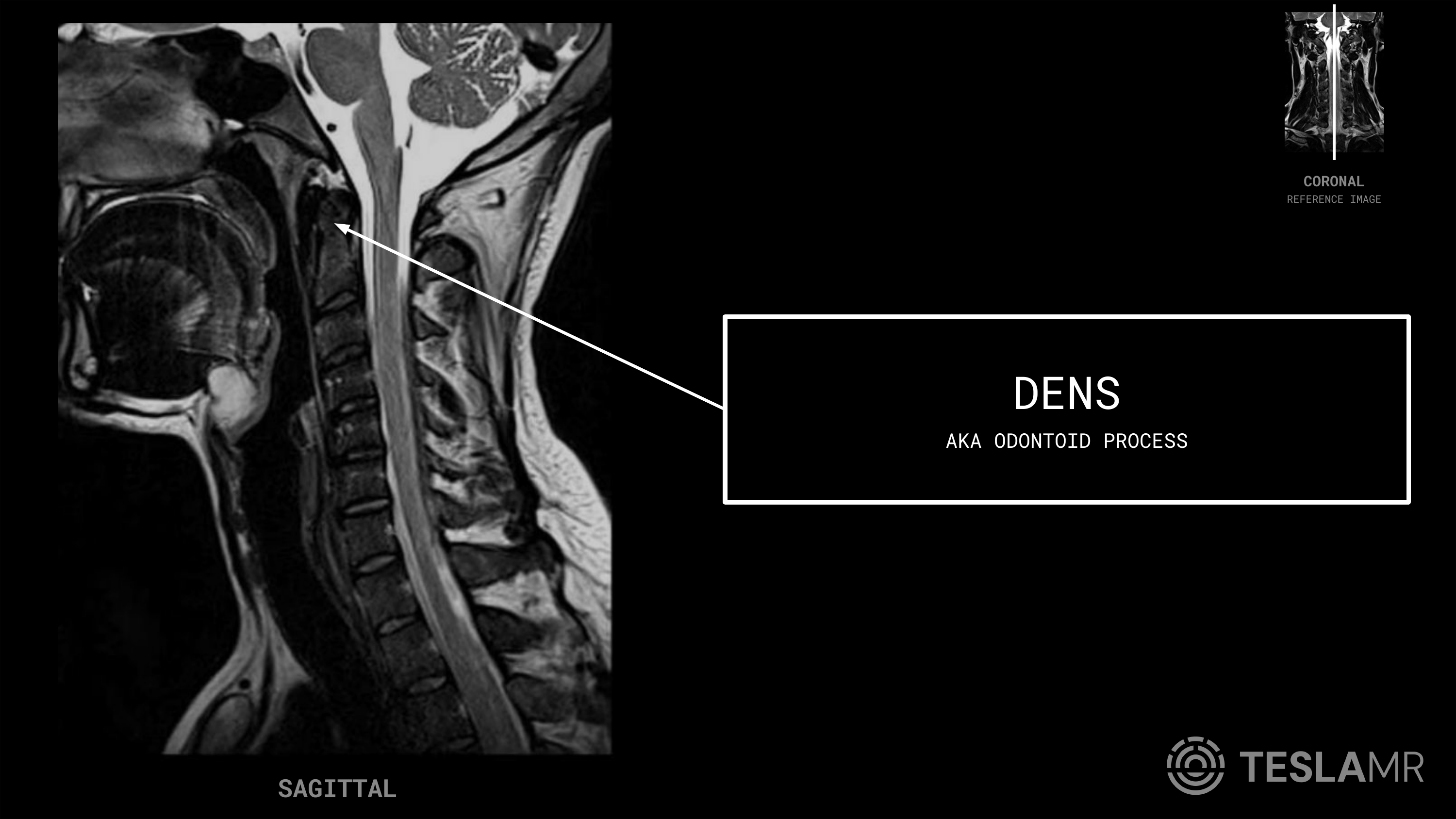 Dens labeled on a C-Spine MRI (Sagittal)