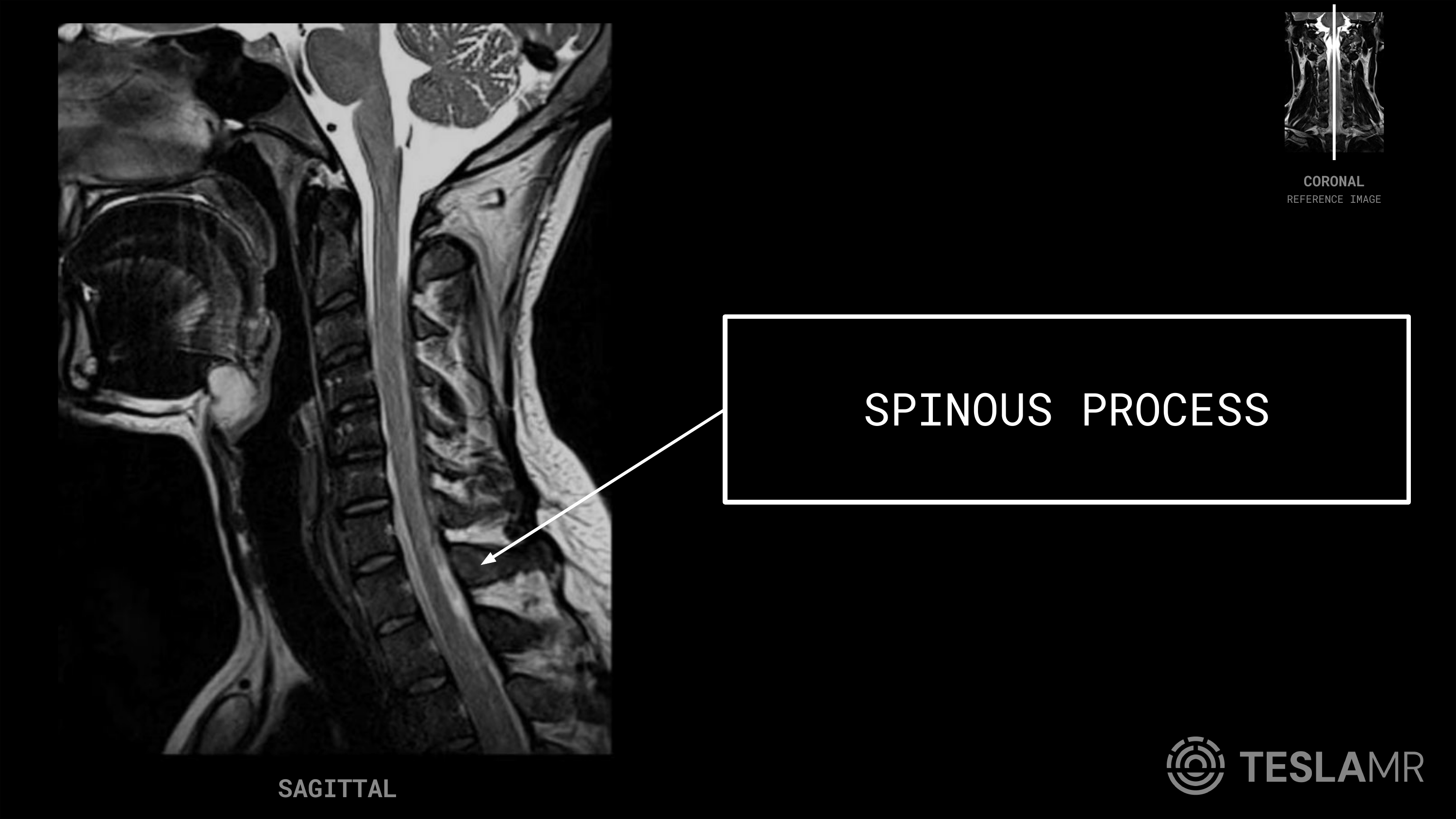 Spinous Process labeled on a C-Spine MRI (Sagittal · Axial)