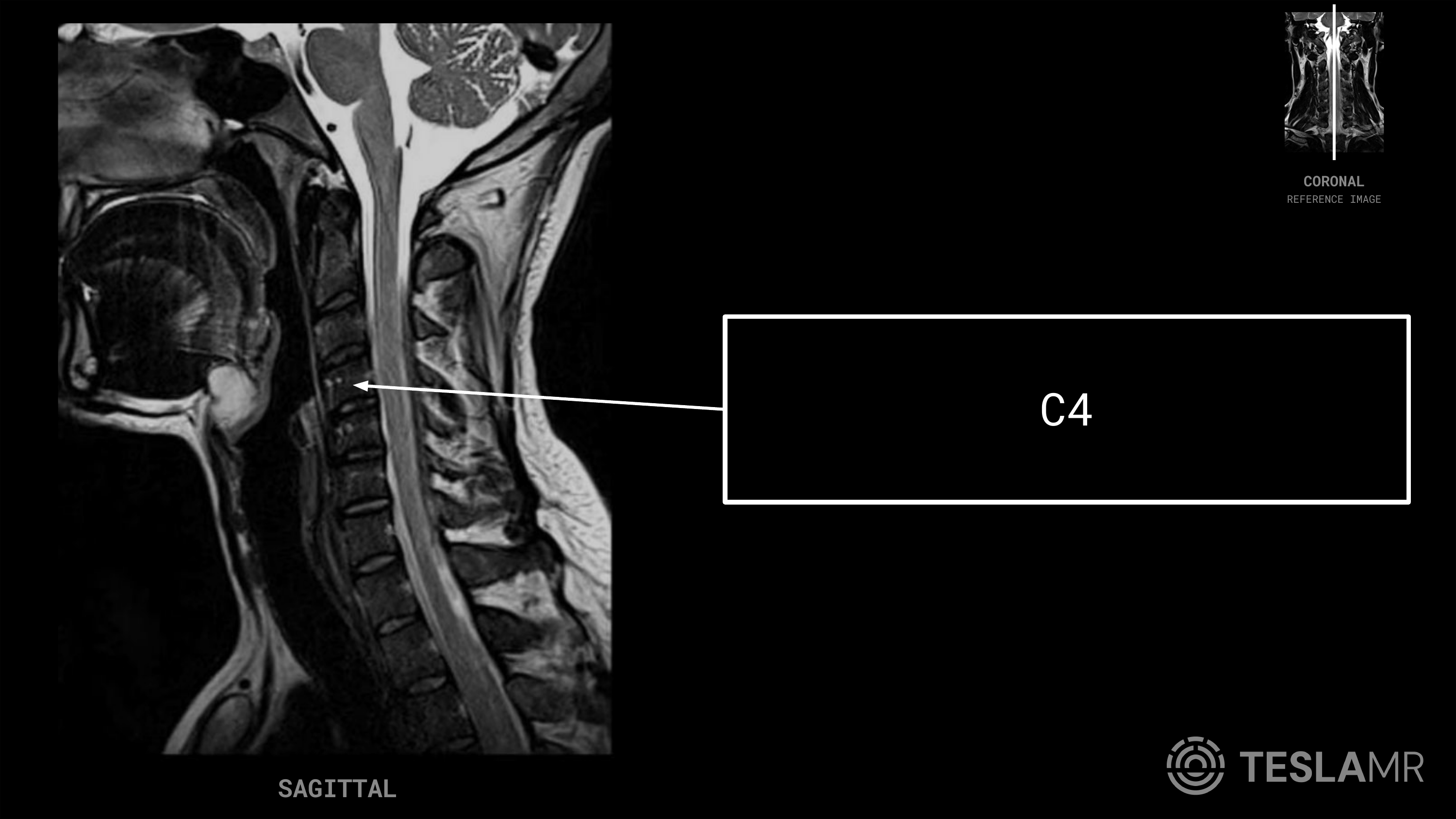 C4 labeled on a C-Spine MRI (Sagittal)