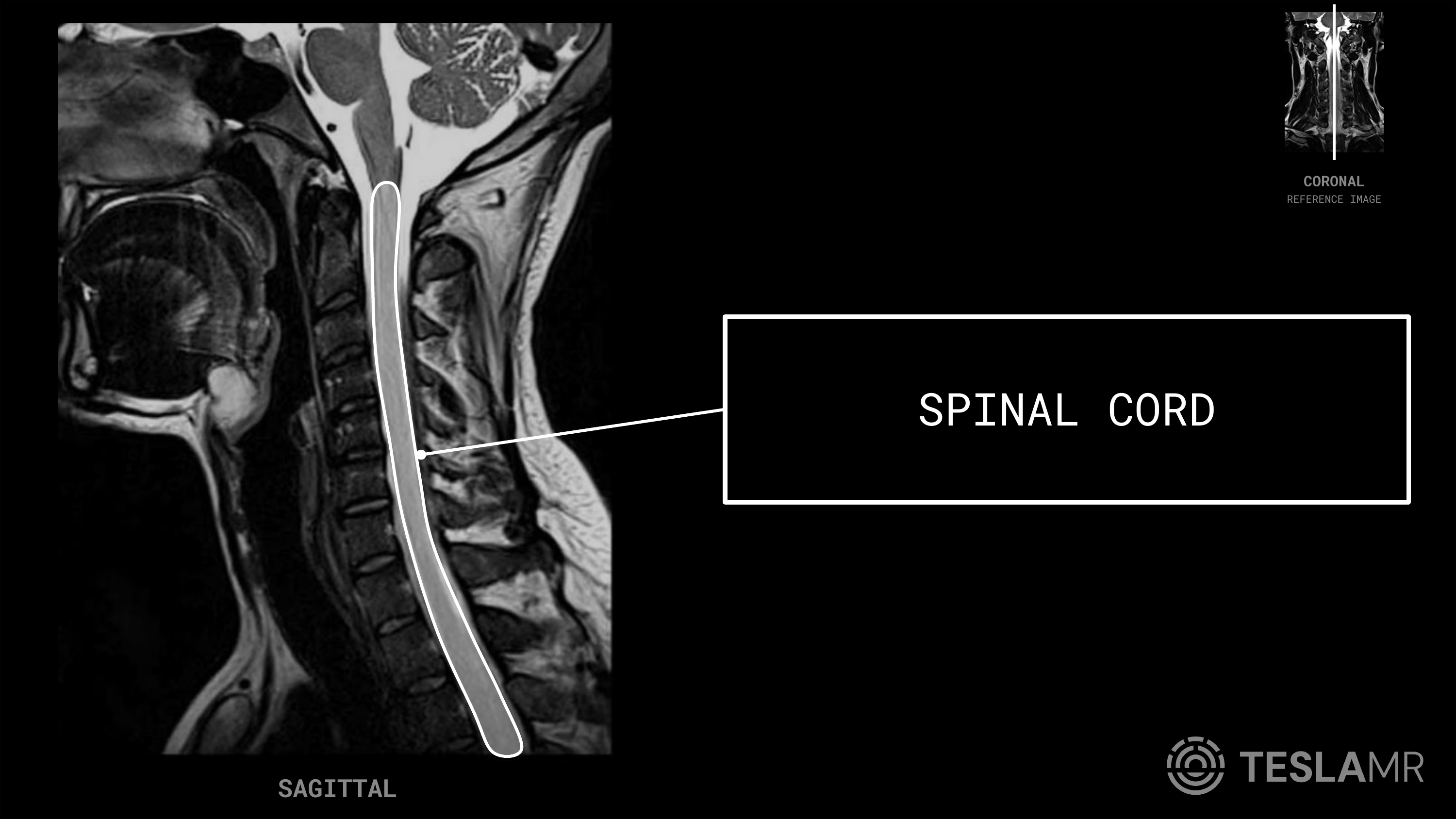 Spinal Cord labeled on a C-Spine MRI (Sagittal)