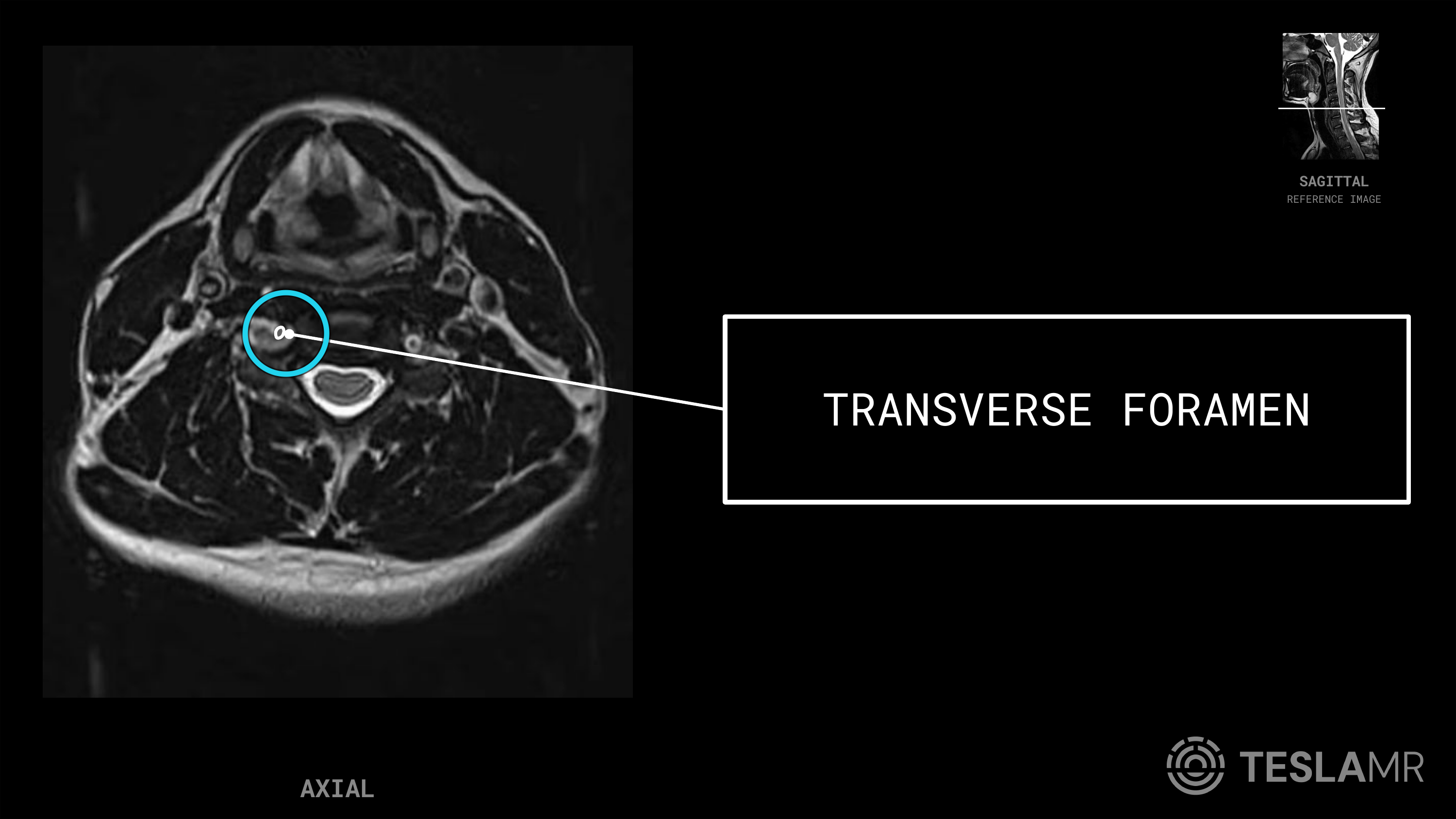 Transverse Foramen labeled on a C-Spine MRI (Axial)