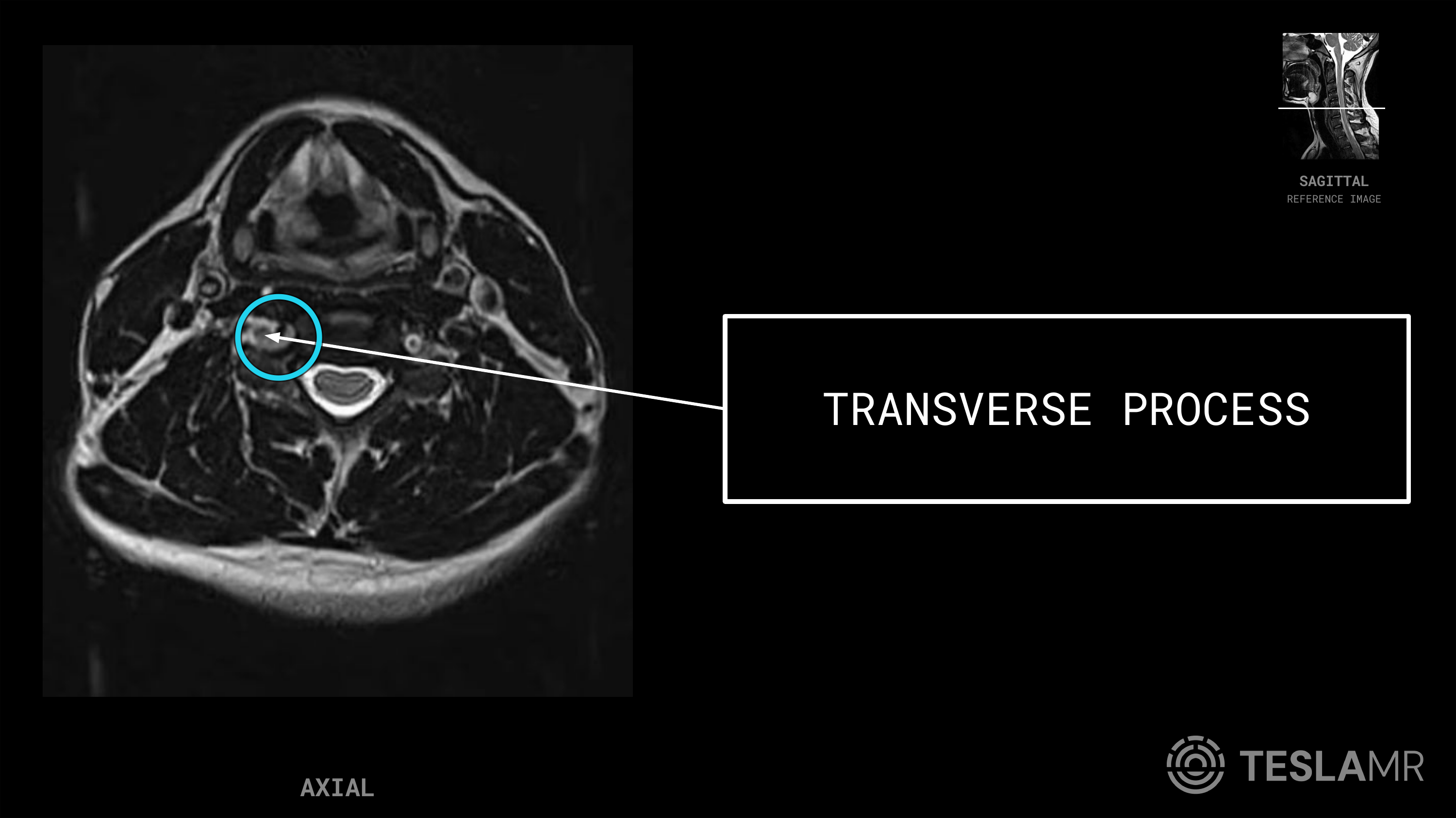 Transverse Process labeled on a C-Spine MRI (Axial)