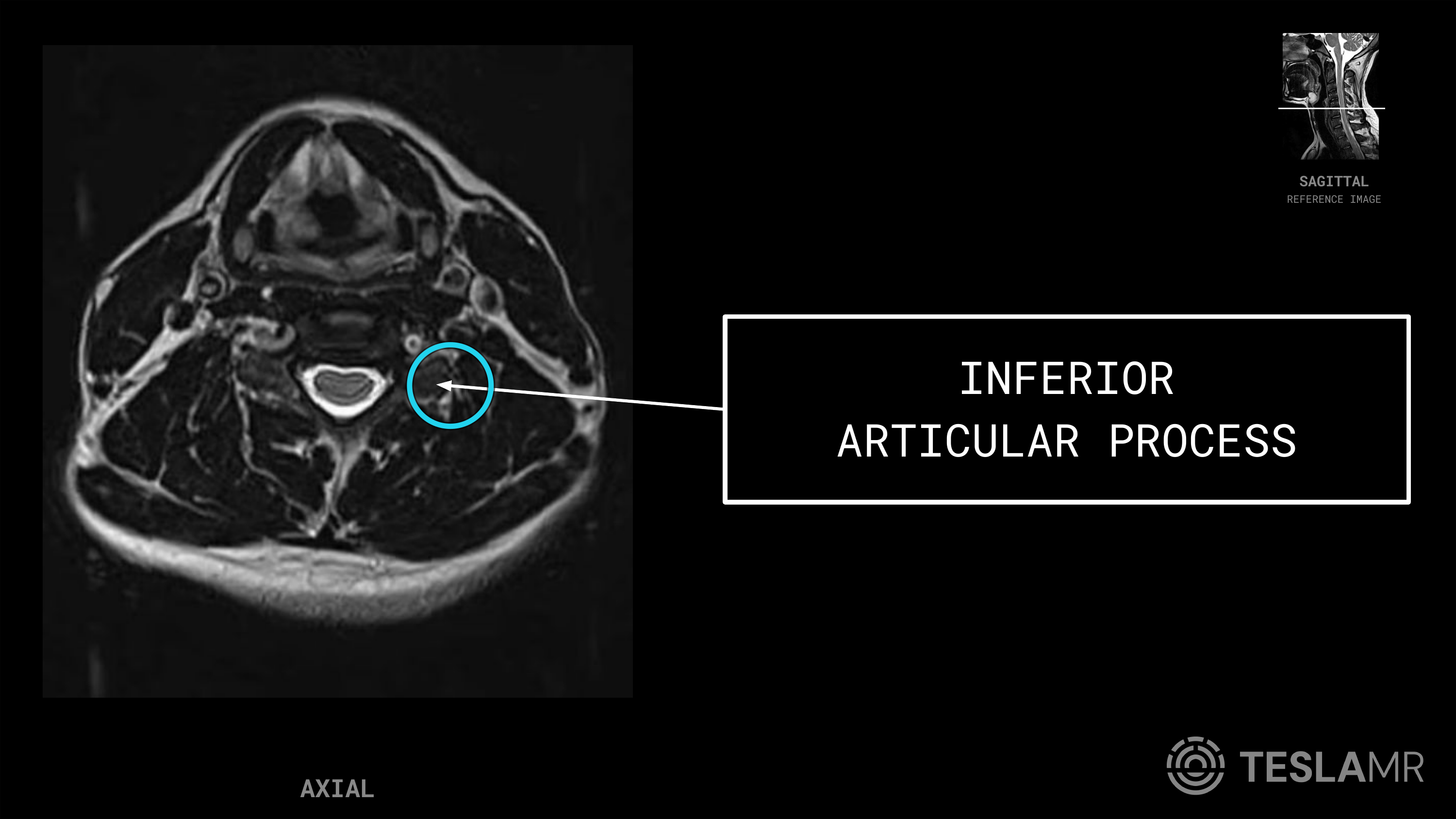 Inferior Articular Process labeled on a C-Spine MRI (Axial)