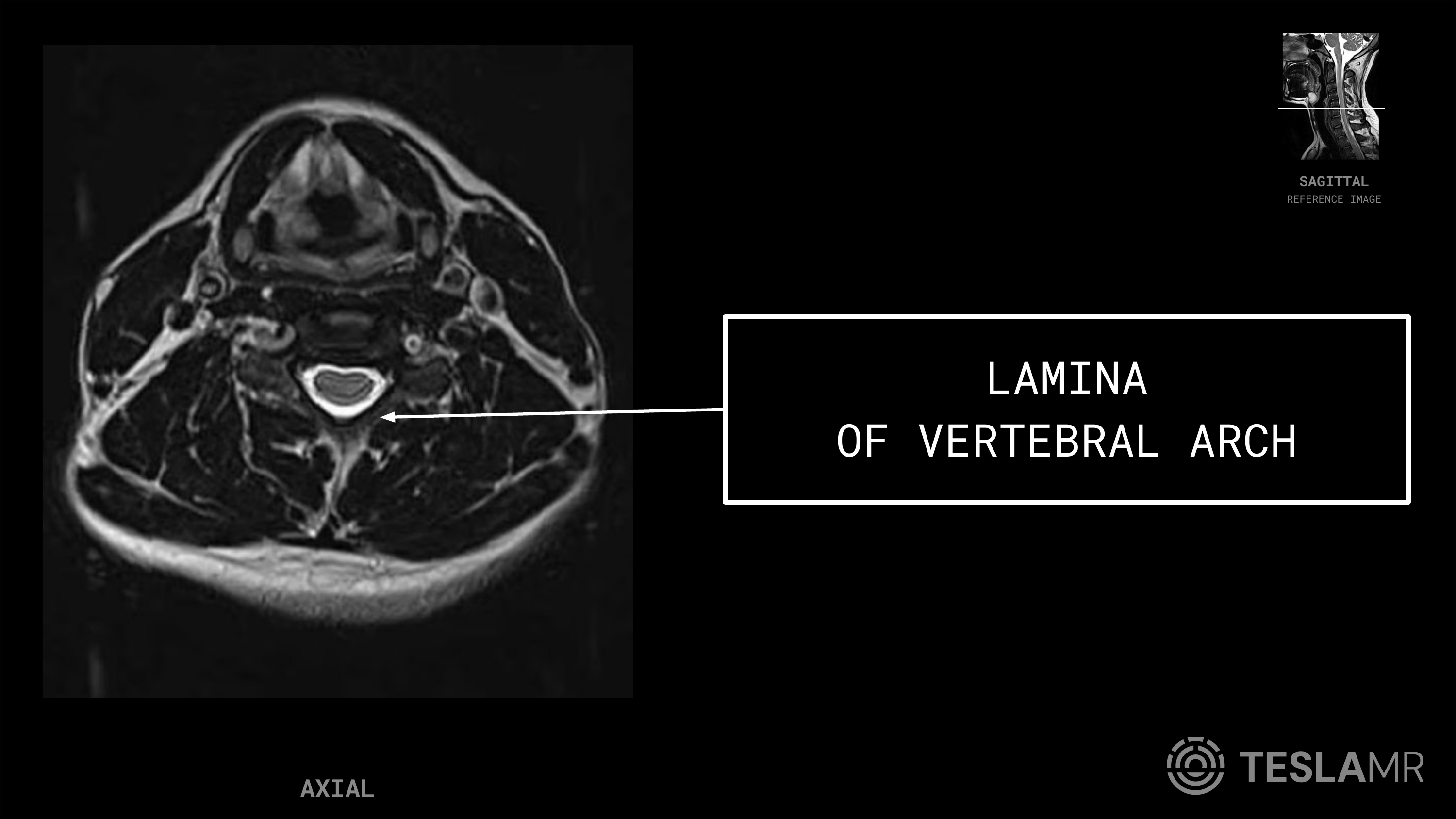 Lamina labeled on a C-Spine MRI (Axial)