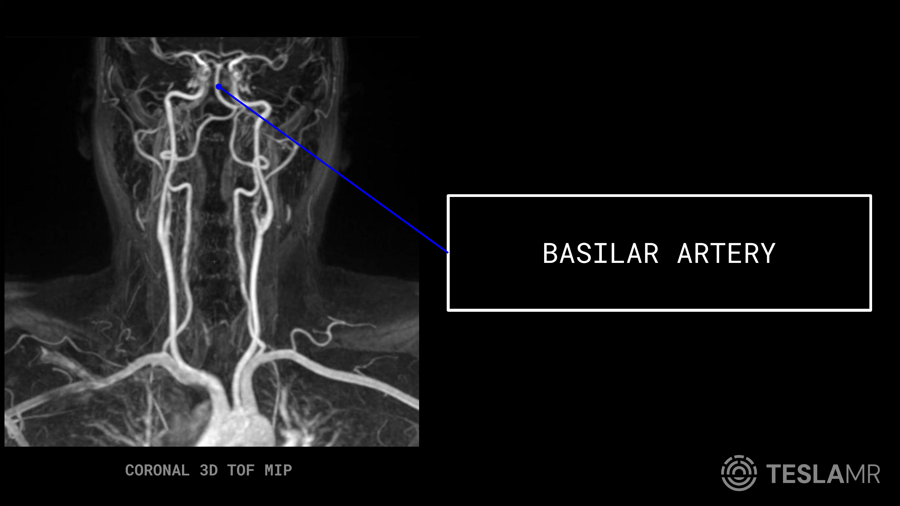 Basilar Artery labeled on a Carotid MRI (Coronal)