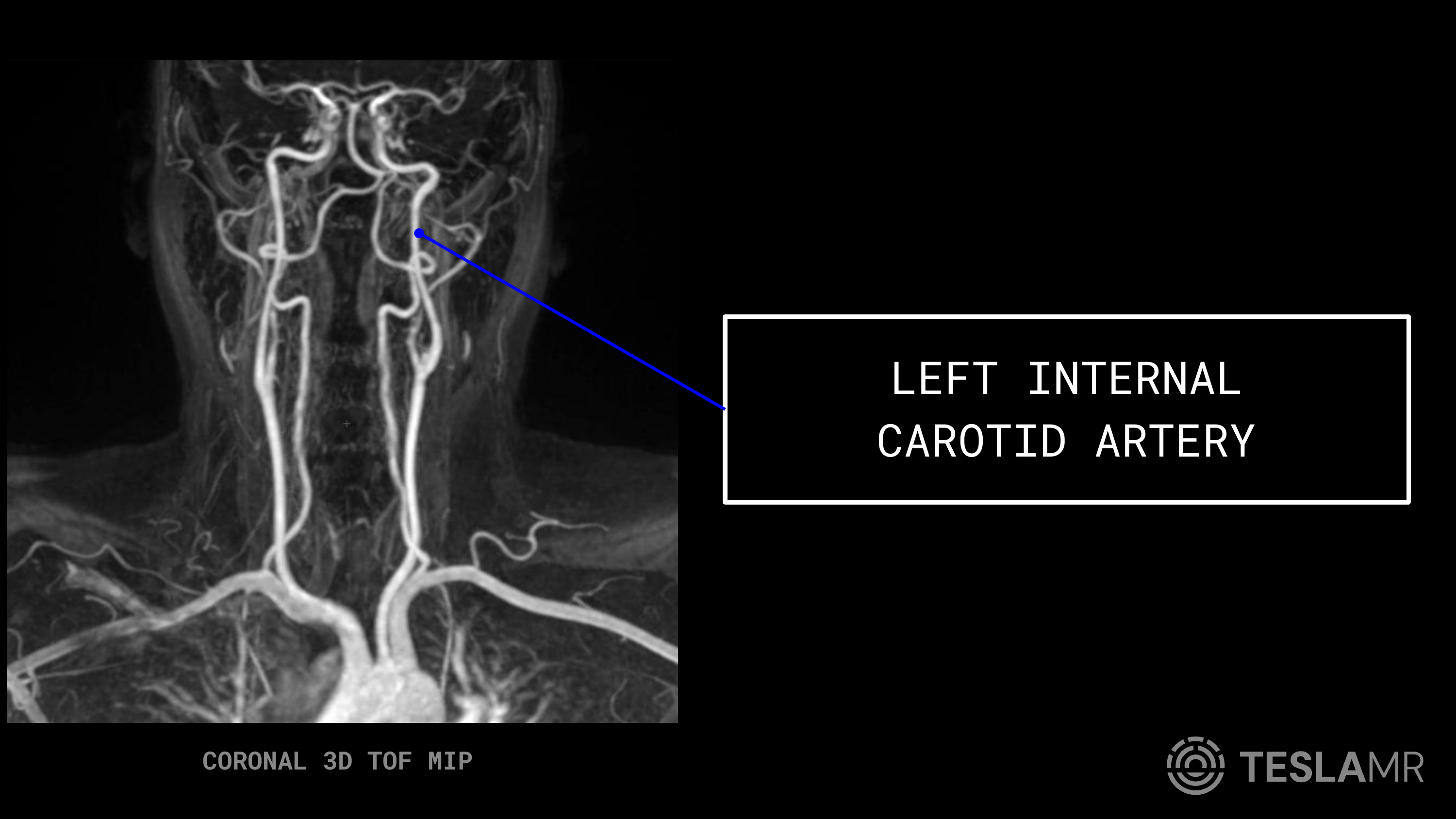 Left Internal Carotid Artery labeled on a Carotid MRI (Coronal)