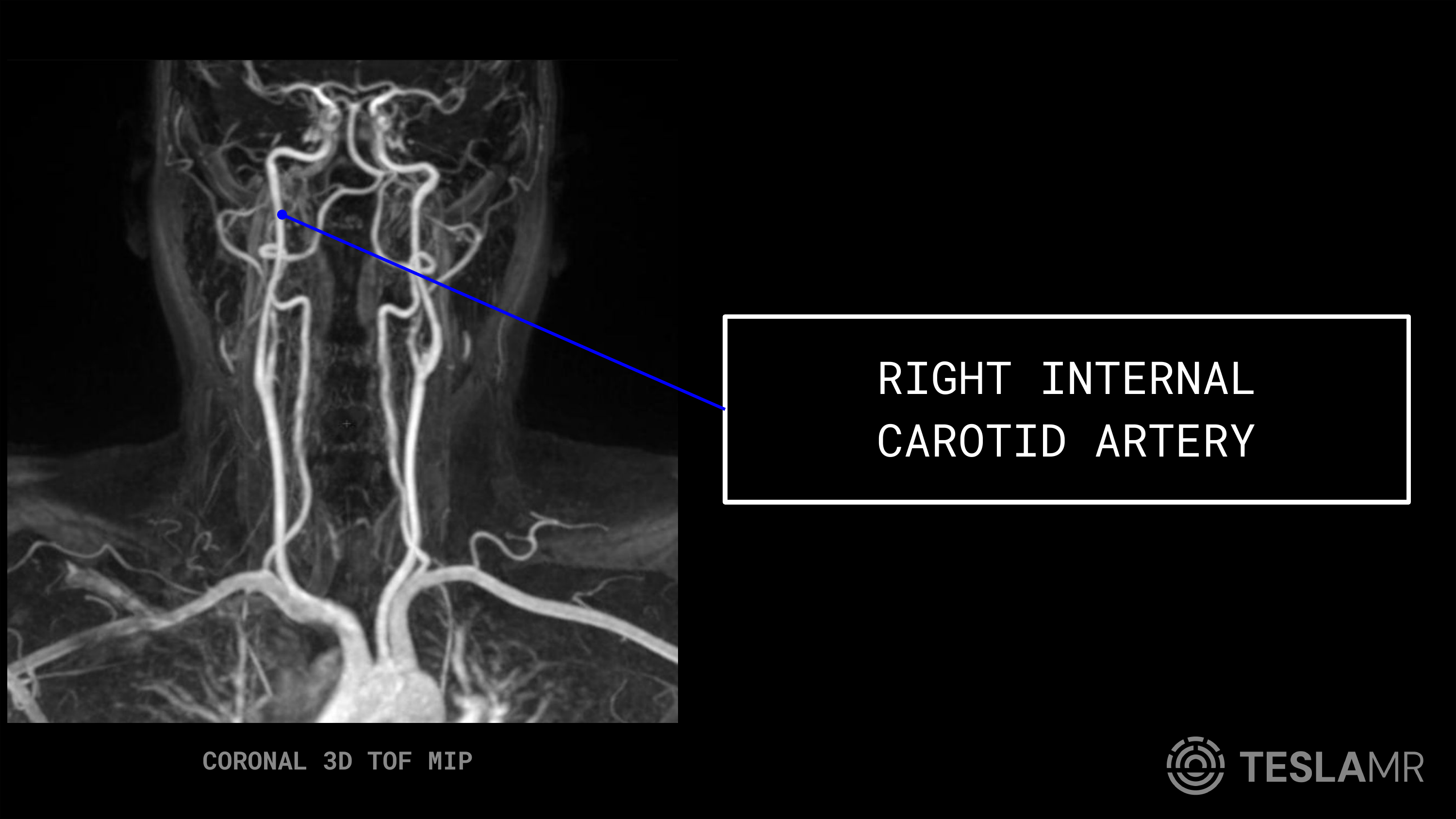 Right Internal Carotid Artery labeled on a Carotid MRI (Coronal)