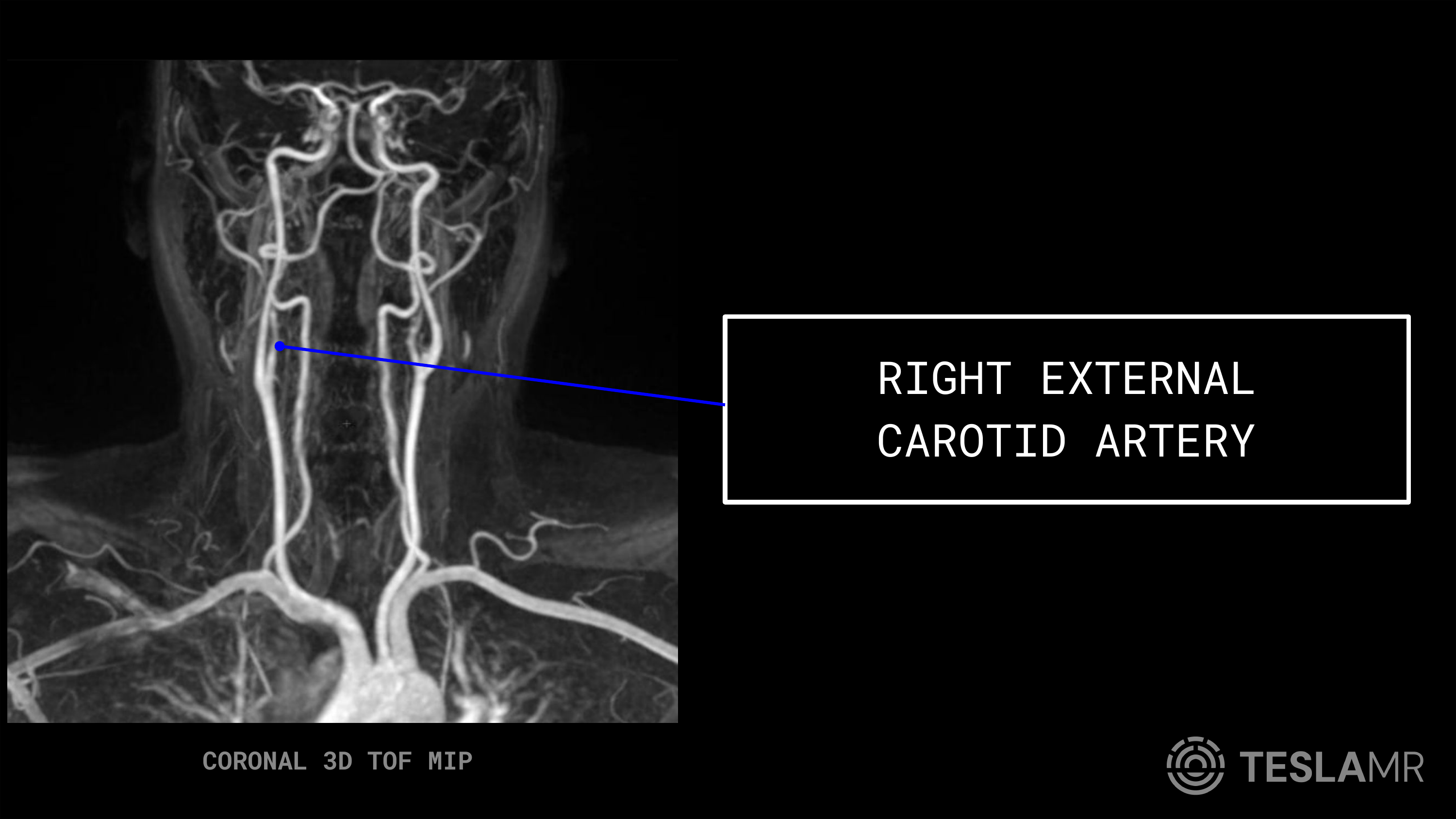 Right External Carotid Artery labeled on a Carotid MRI (Coronal)