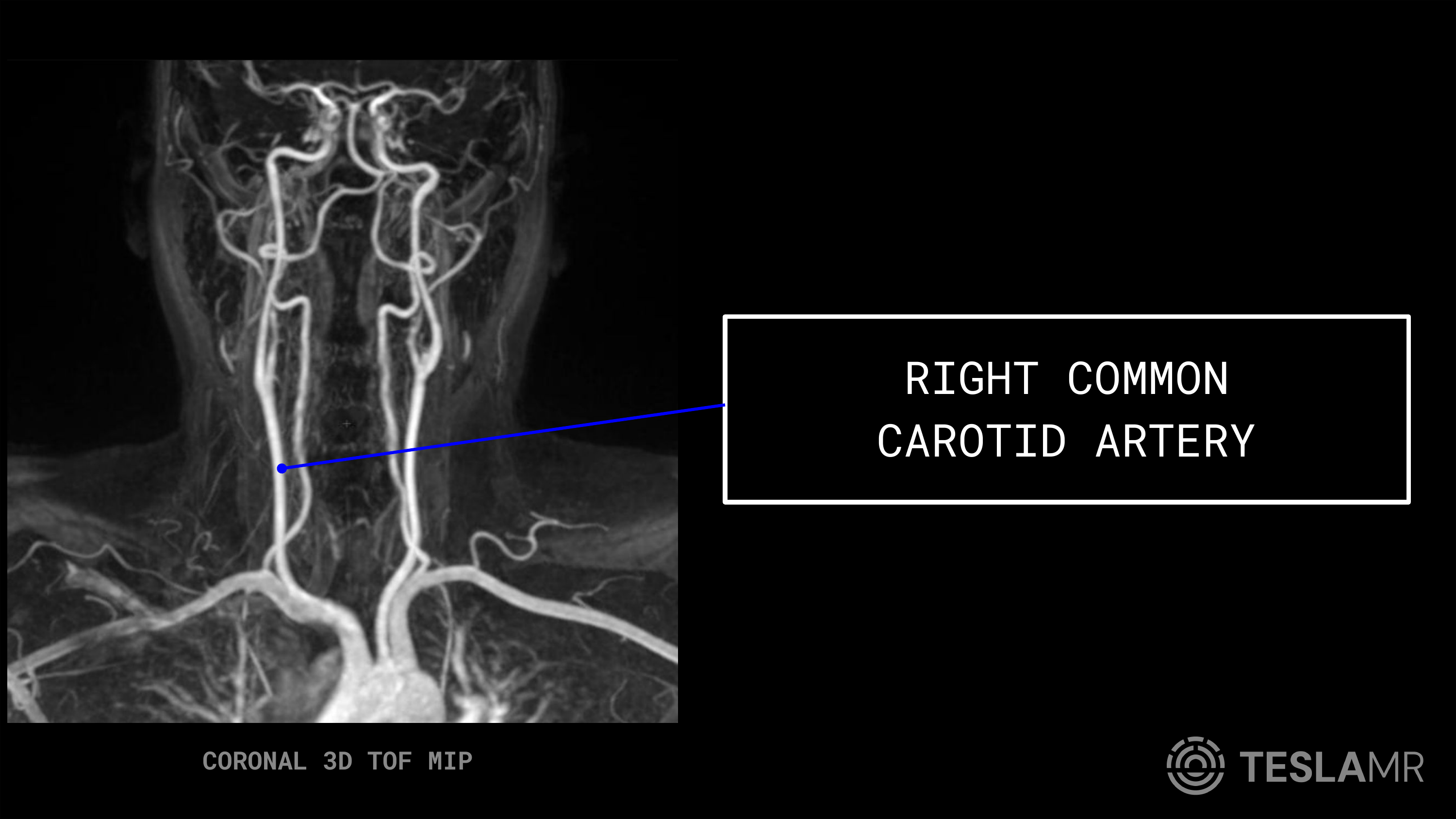 Right Common Carotid Artery labeled on a Carotid MRI (Coronal)