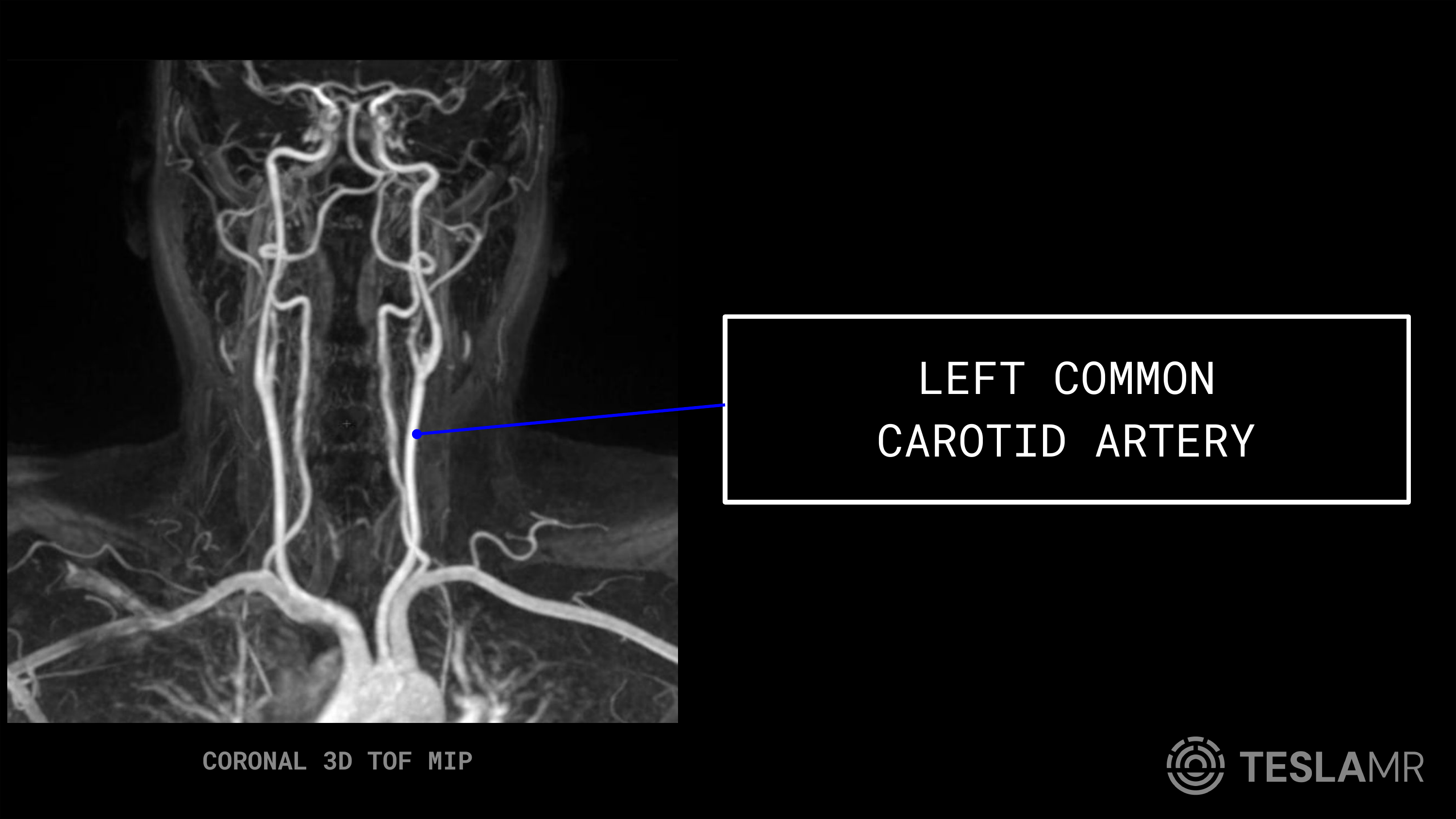 Left Common Carotid Artery labeled on a Carotid MRI (Coronal)