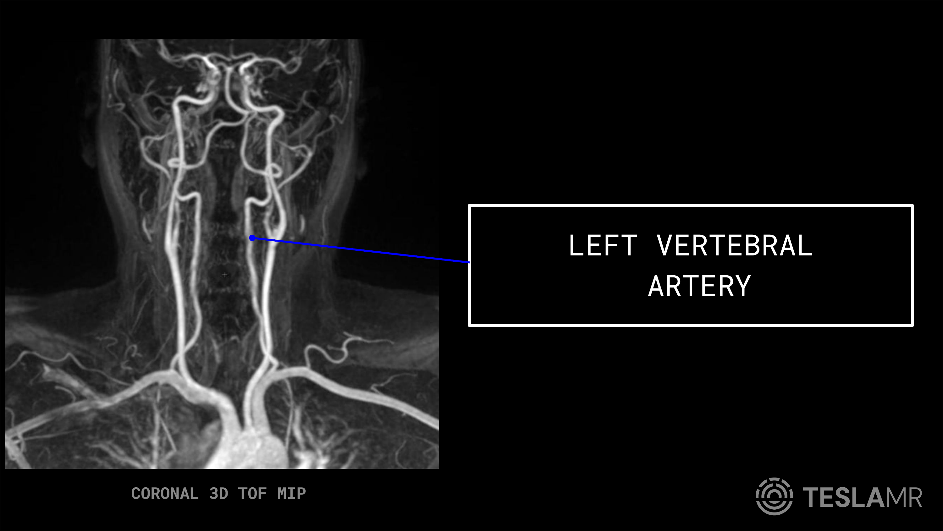 Left Vertebral Artery labeled on a Carotid MRI (Coronal)