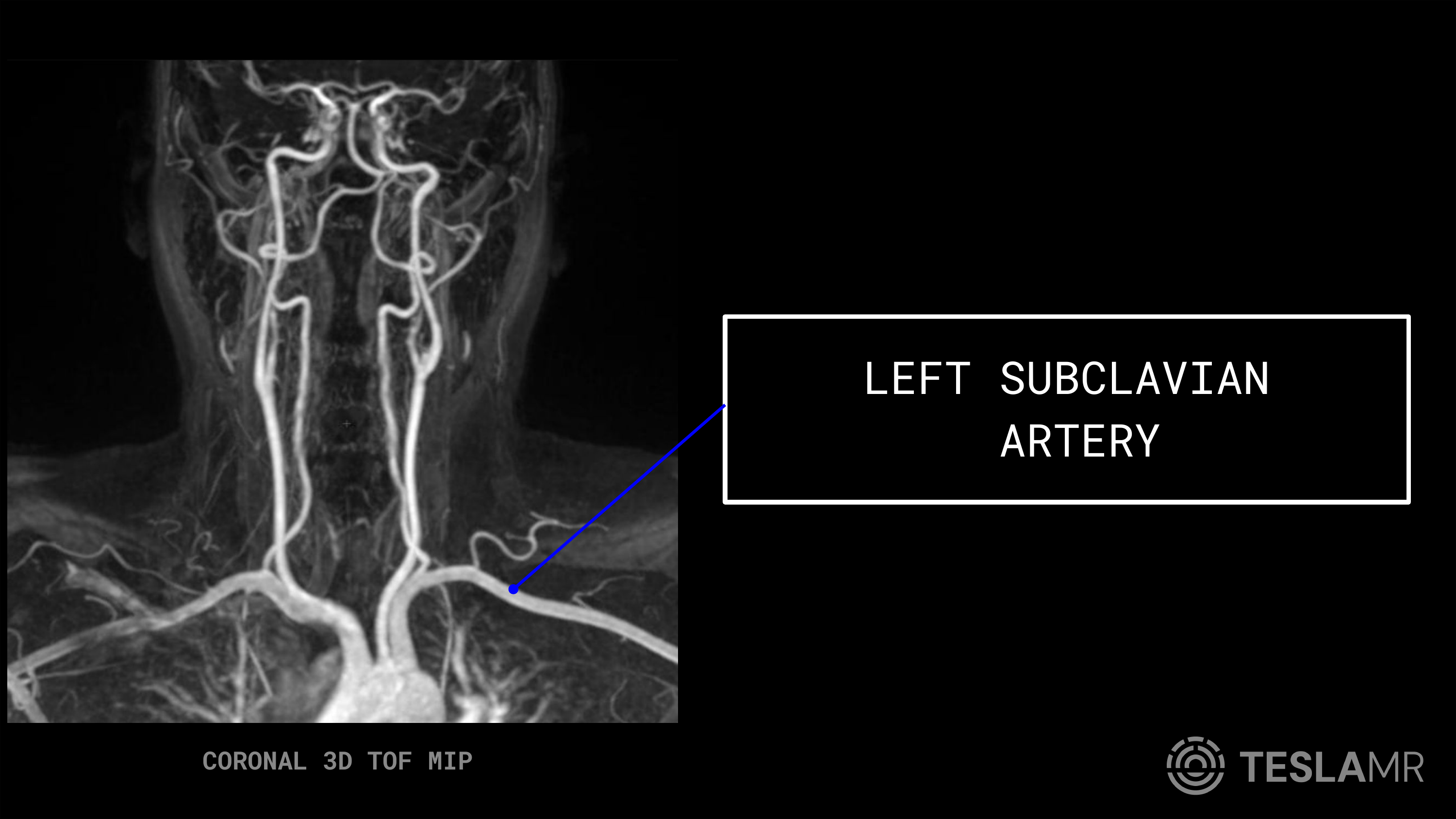 Left Subclavian Artery labeled on a Carotid MRI (Coronal)