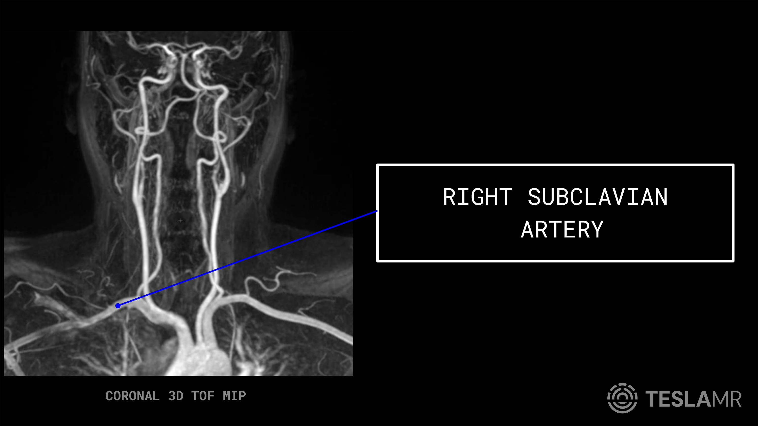 Right Subclavian Artery labeled on a Carotid MRI (Coronal)