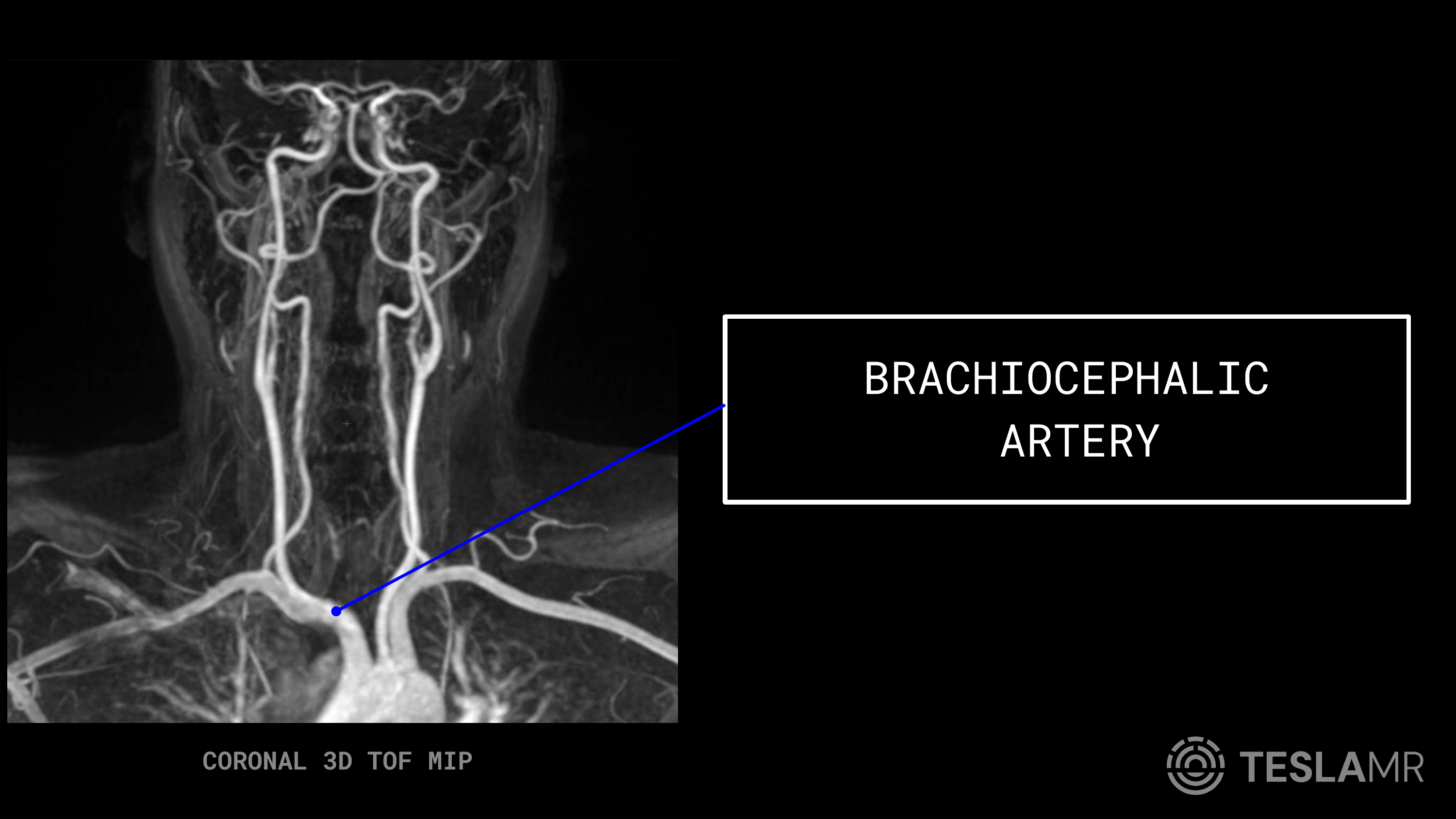 Brachiocephalic Artery labeled on a Carotid MRI (Coronal)