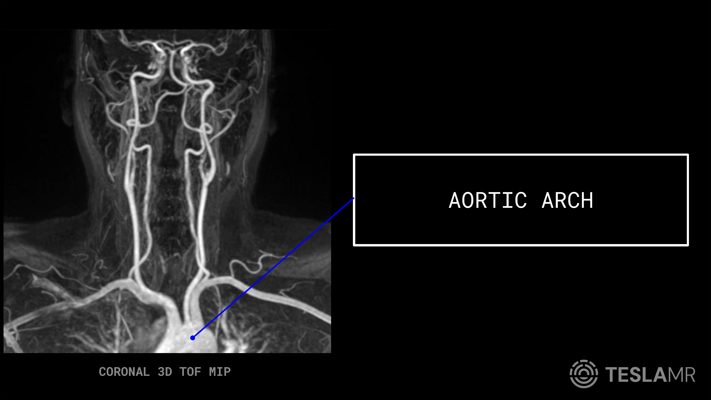 Aortic Arch labeled on a Carotid MRI (Coronal)