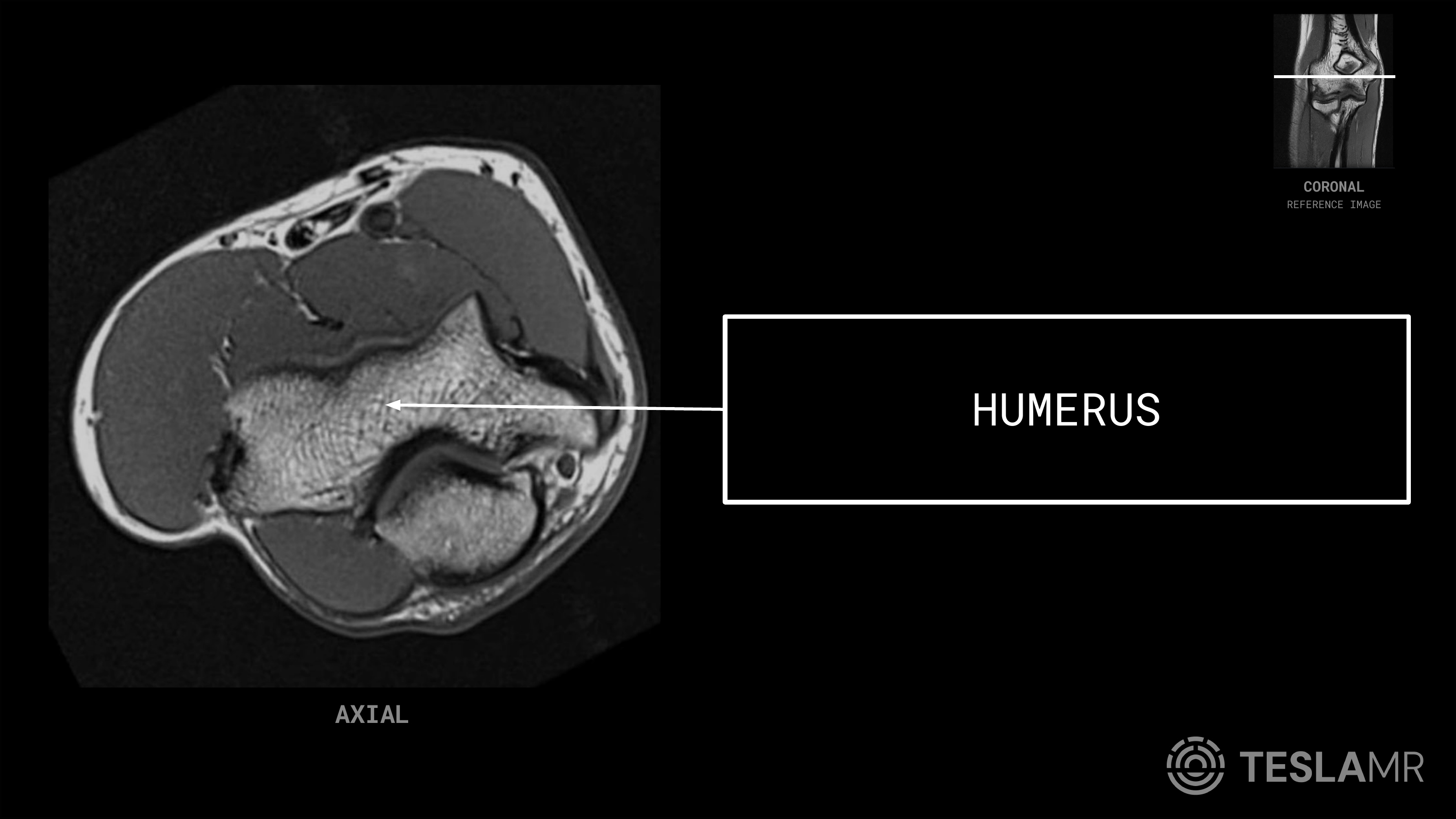 Humerus labeled on a Elbow MRI (Axial · Coronal · Sagittal)