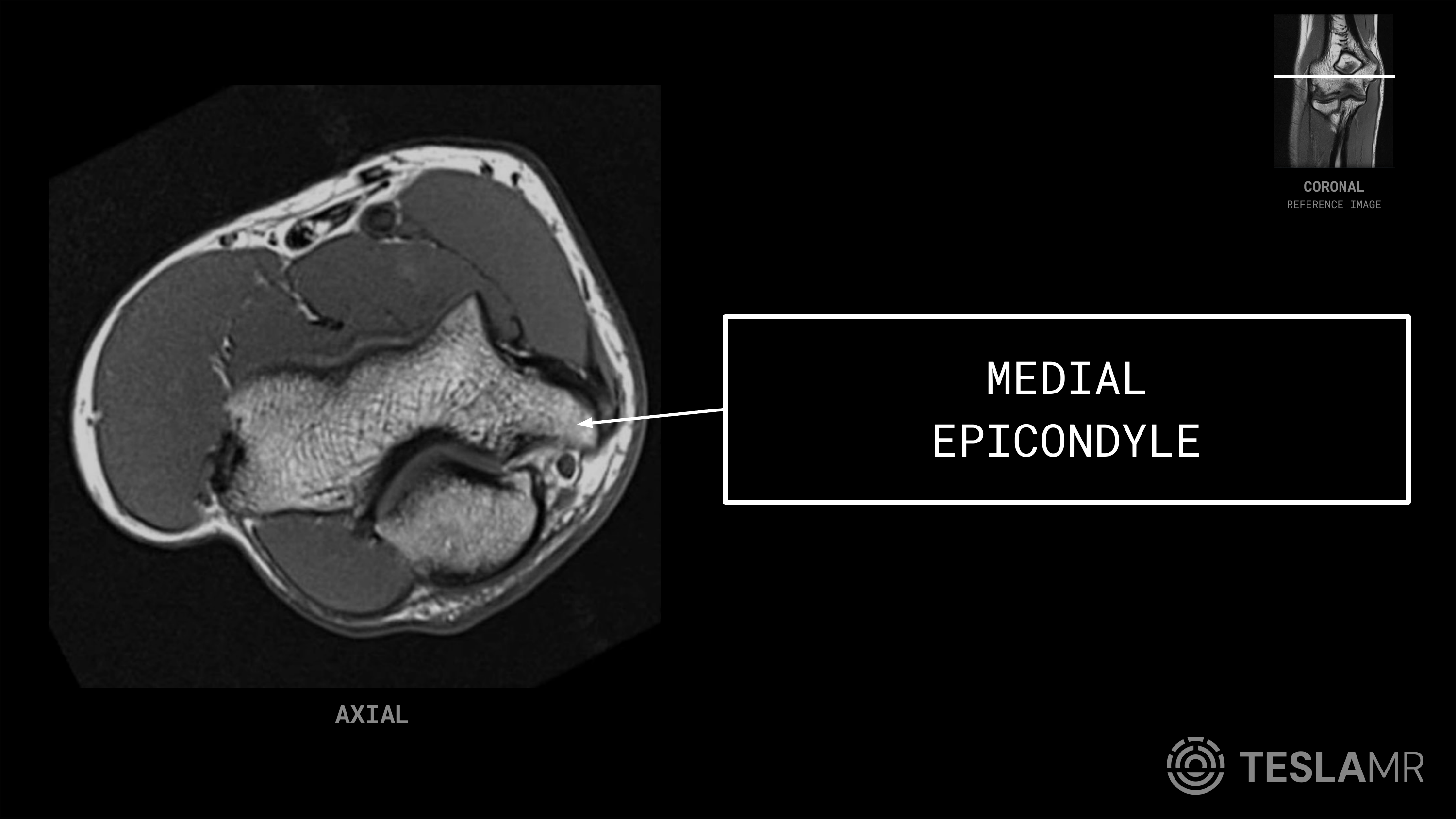 Medial Epicondyle labeled on a Elbow MRI (Axial · Coronal)