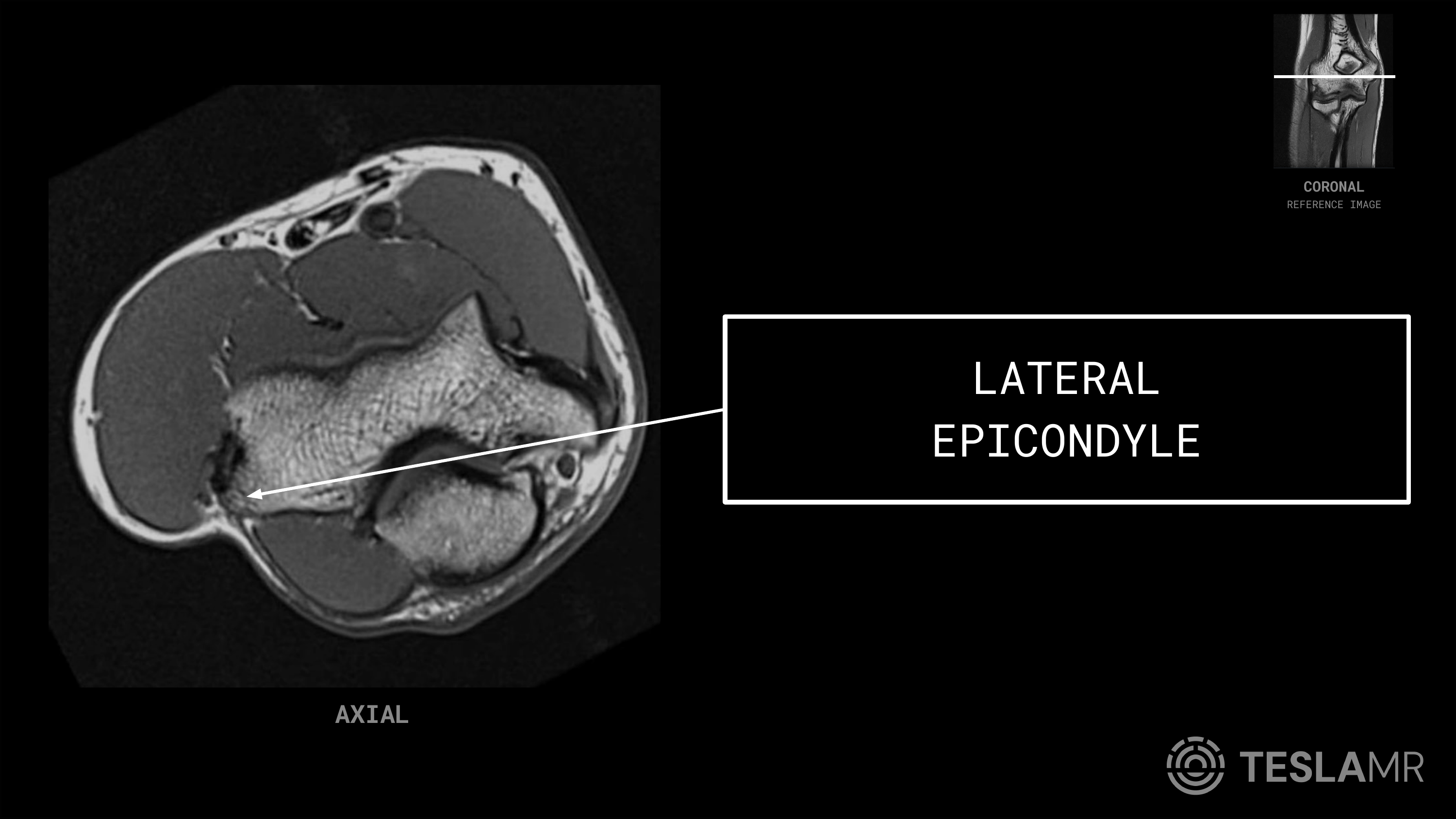 Lateral Epicondyle labeled on a Elbow MRI (Axial · Coronal)