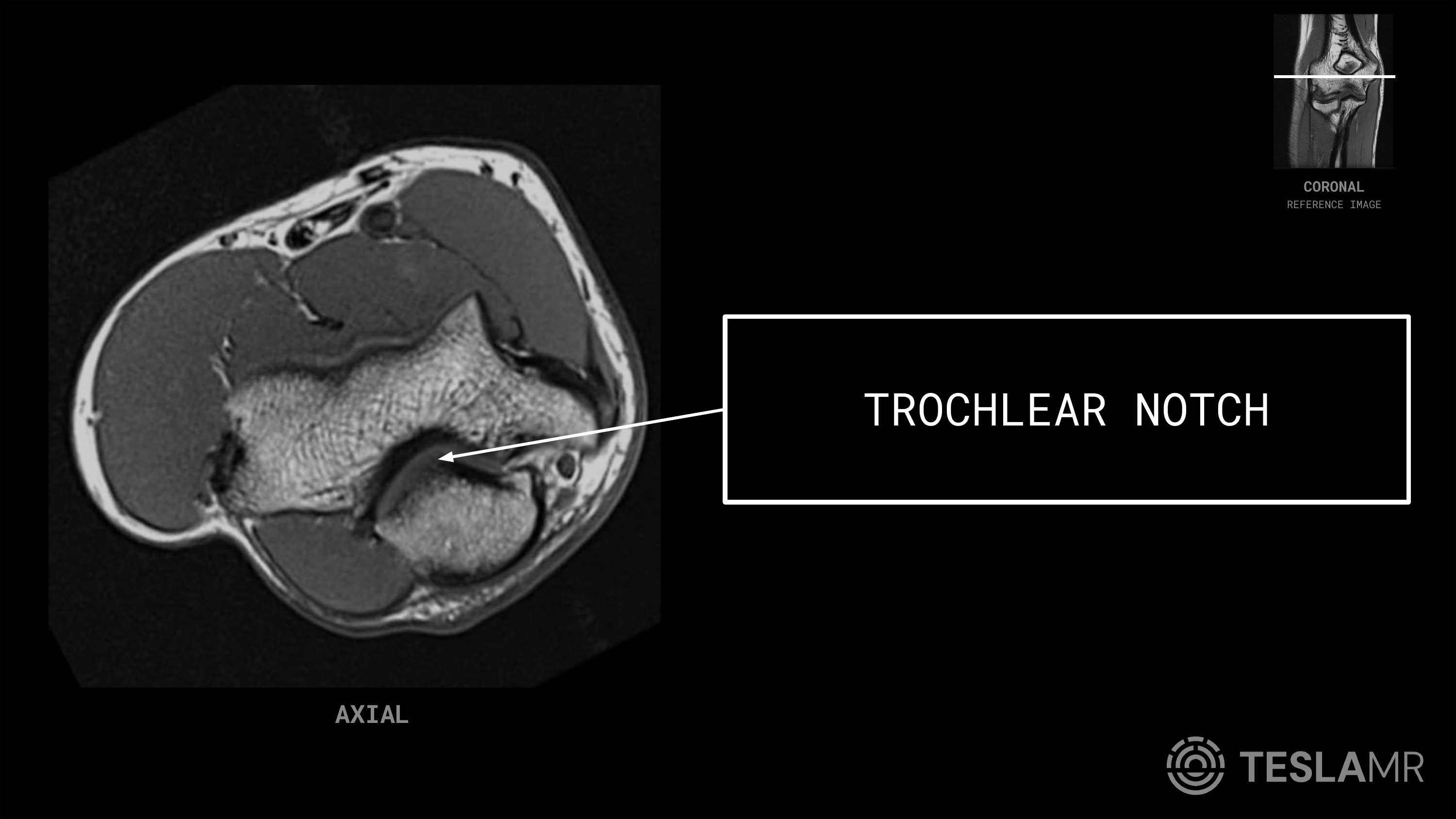 Trochlear Notch labeled on a Elbow MRI (Axial · Coronal)