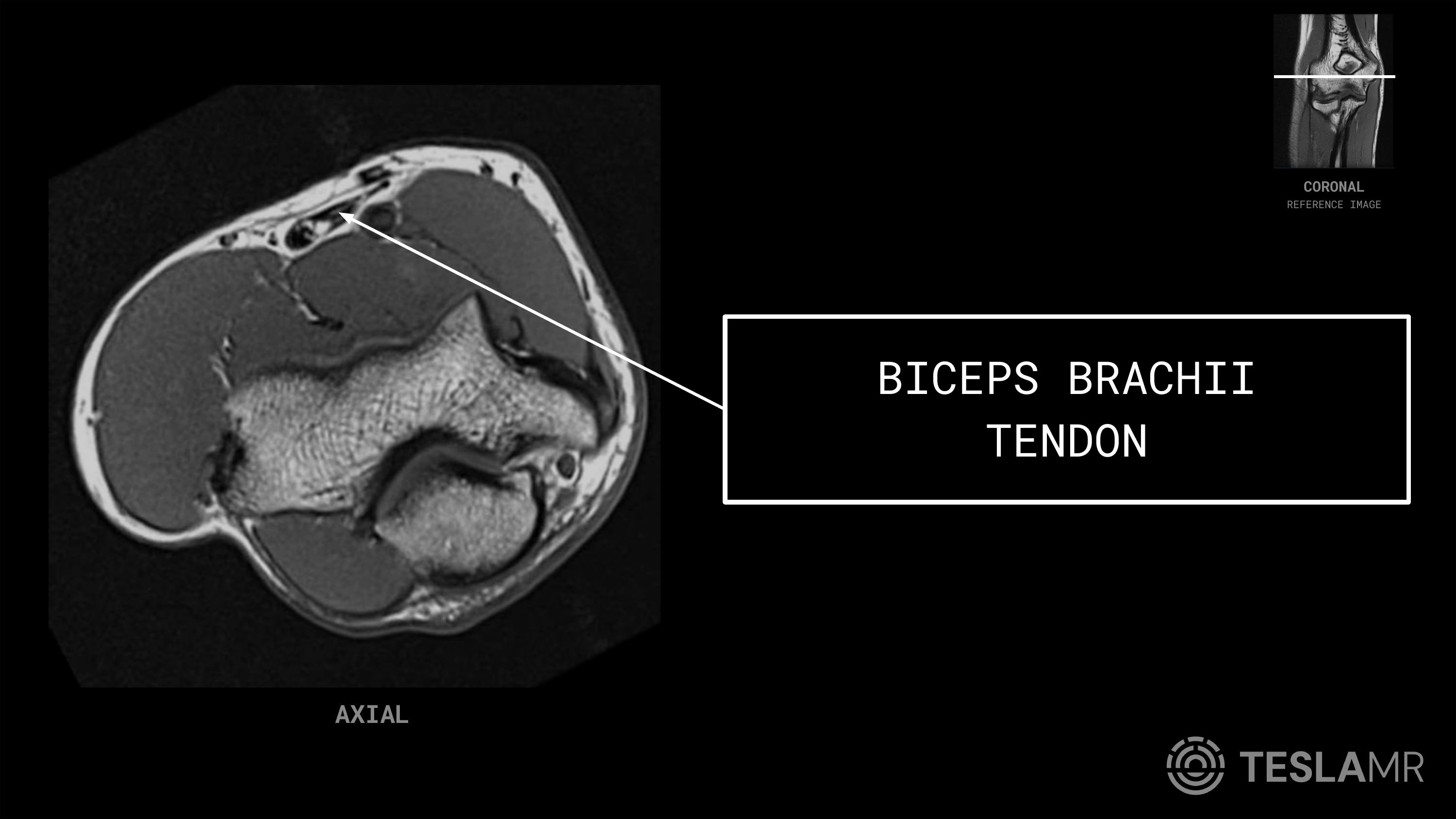 Biceps Brachii Tendon labeled on a Elbow MRI (Axial · Sagittal)