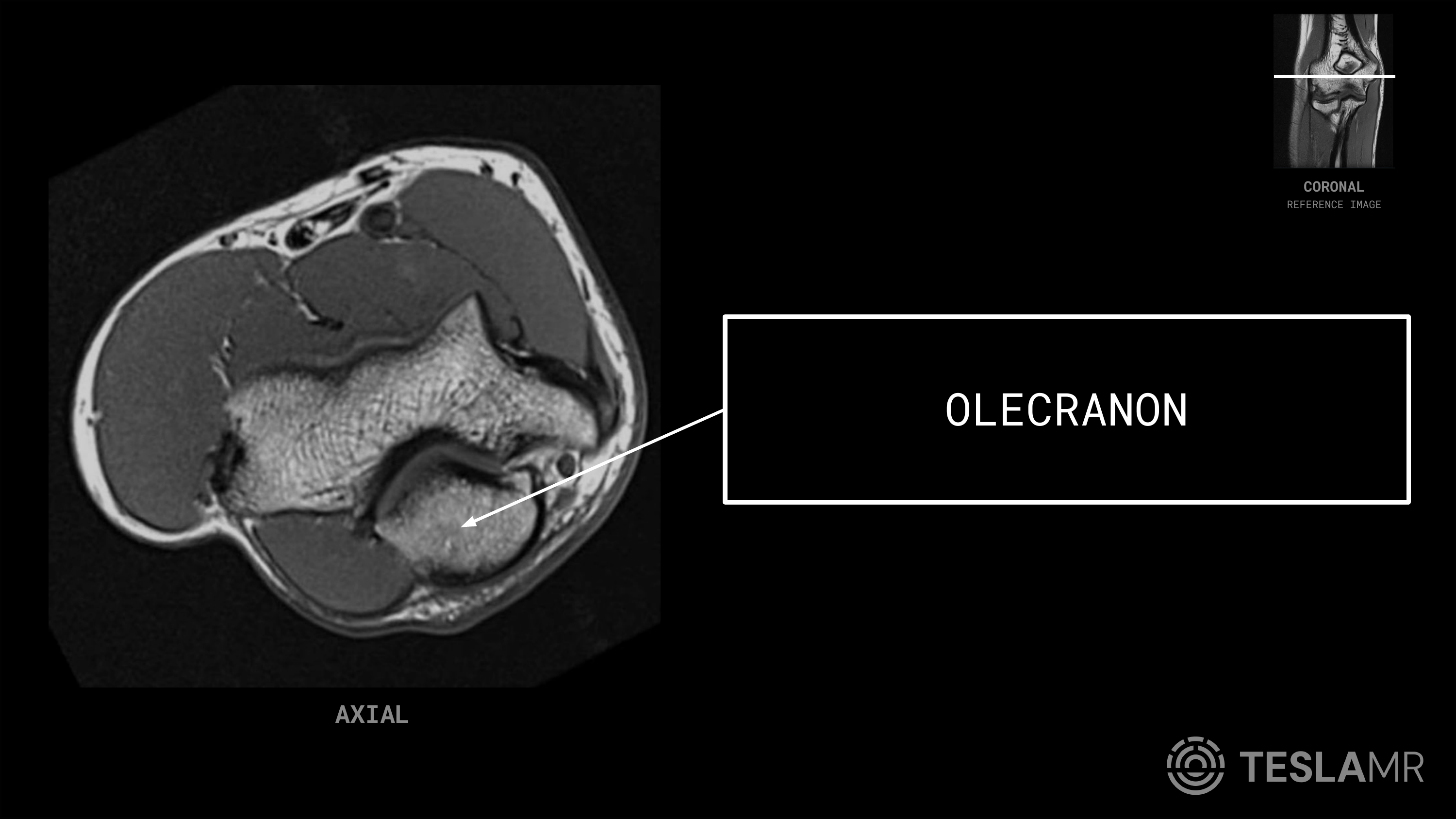 Olecranon labeled on a Elbow MRI (Axial · Coronal)