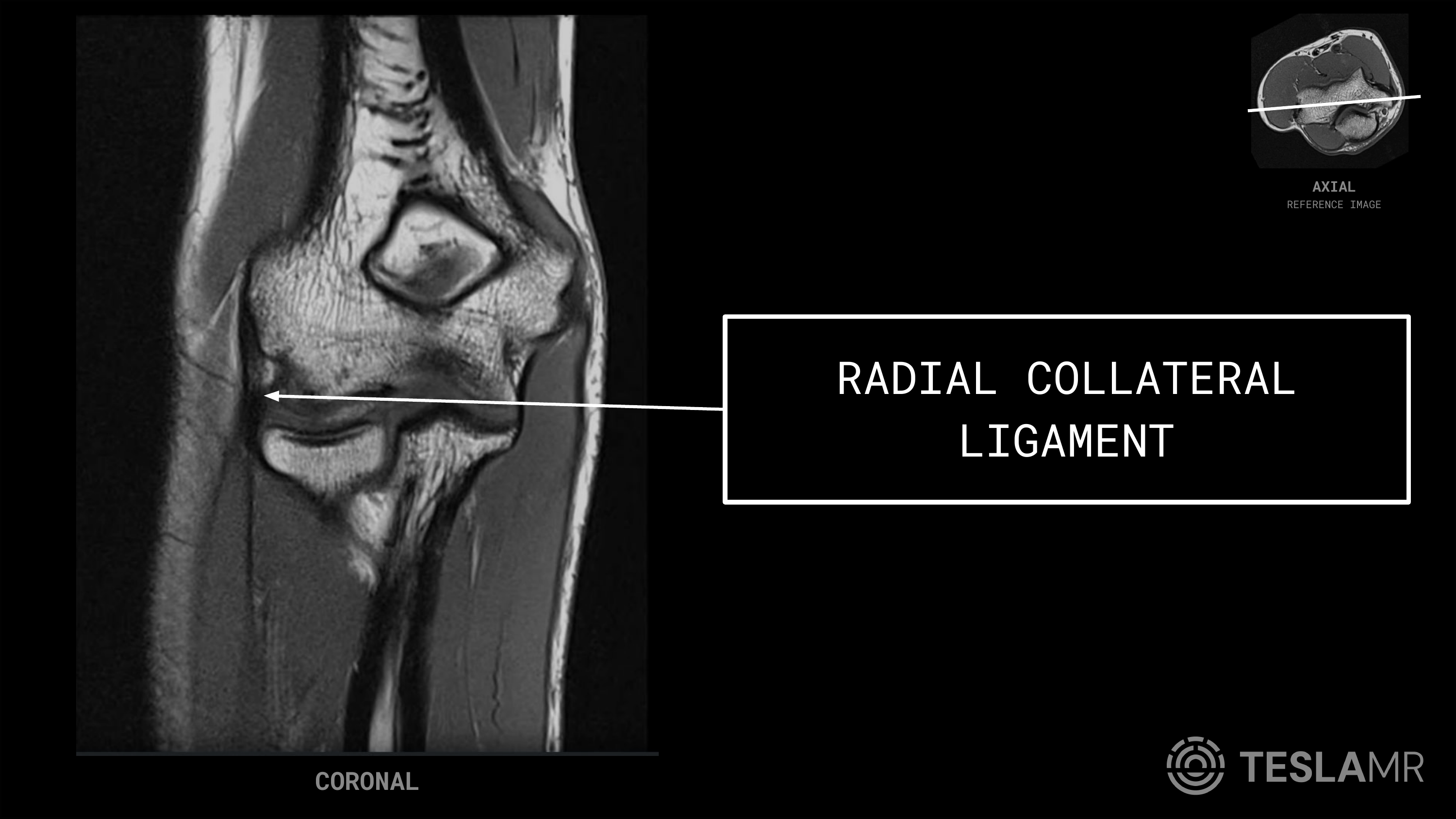 Radial Collateral Ligament labeled on a Elbow MRI (Coronal)