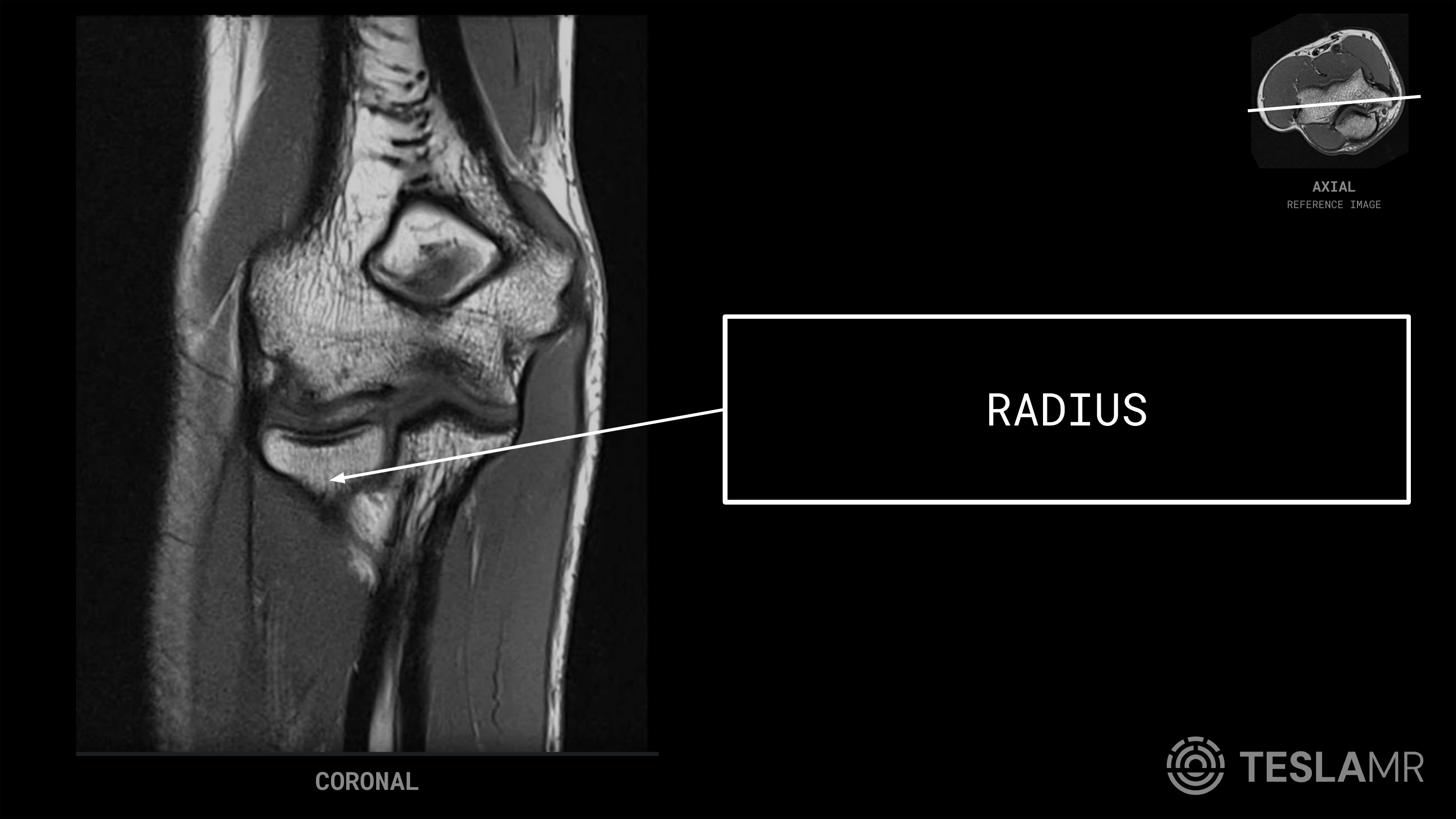 Radius labeled on a Elbow MRI (Coronal)