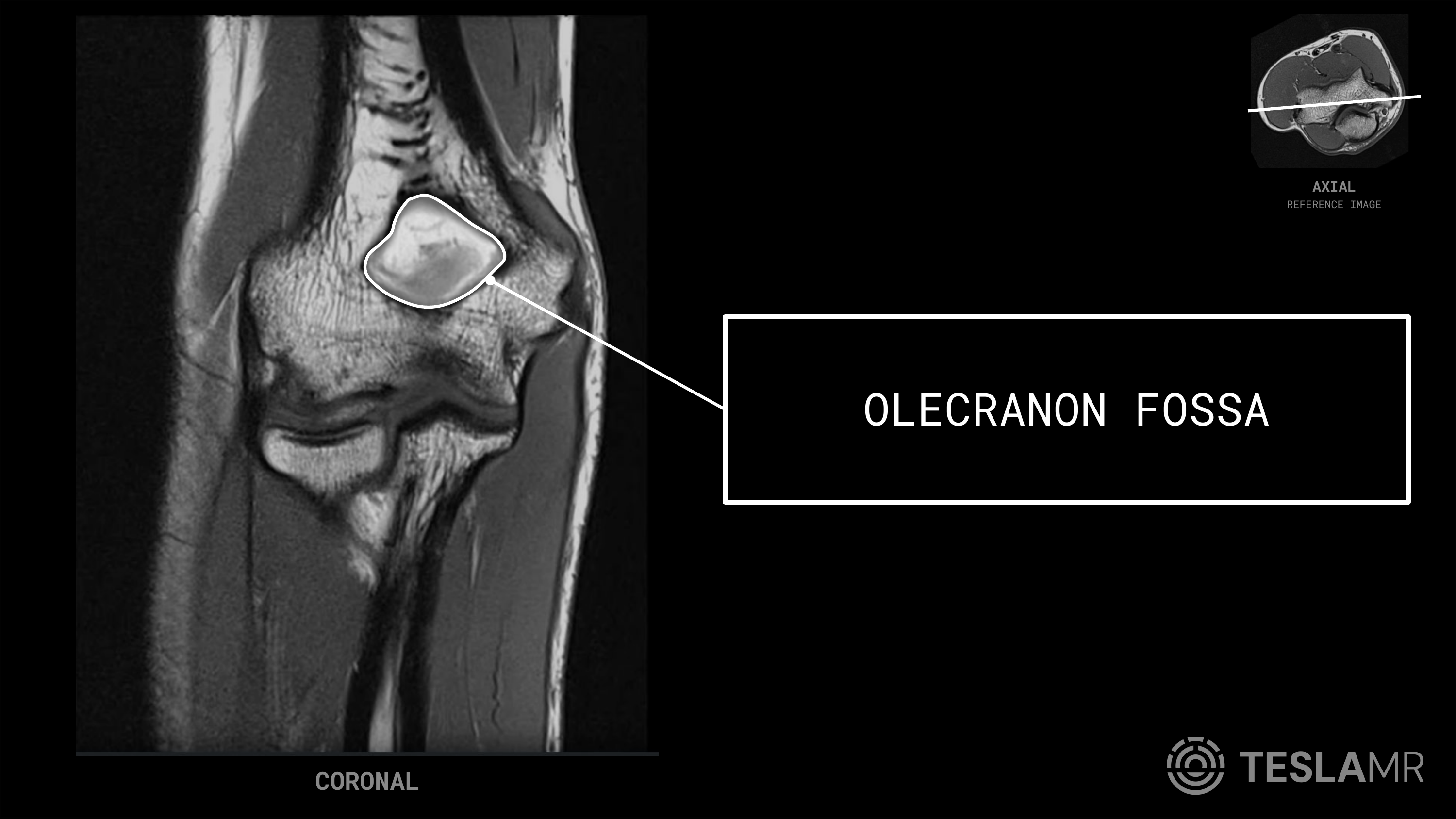 Olecranon Fossa labeled on a Elbow MRI (Coronal)