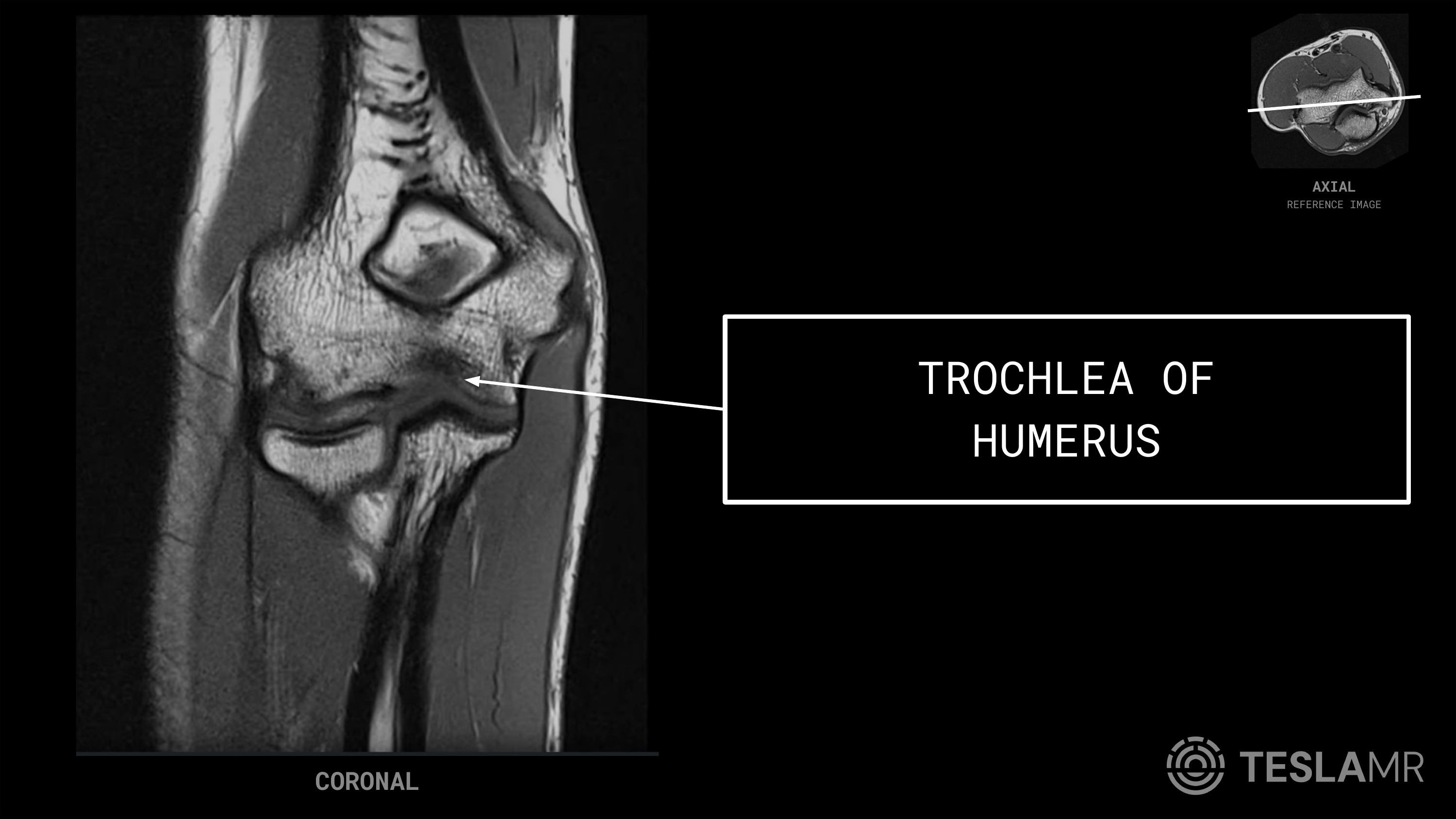 Trochlea of Humerus labeled on a Elbow MRI (Coronal)