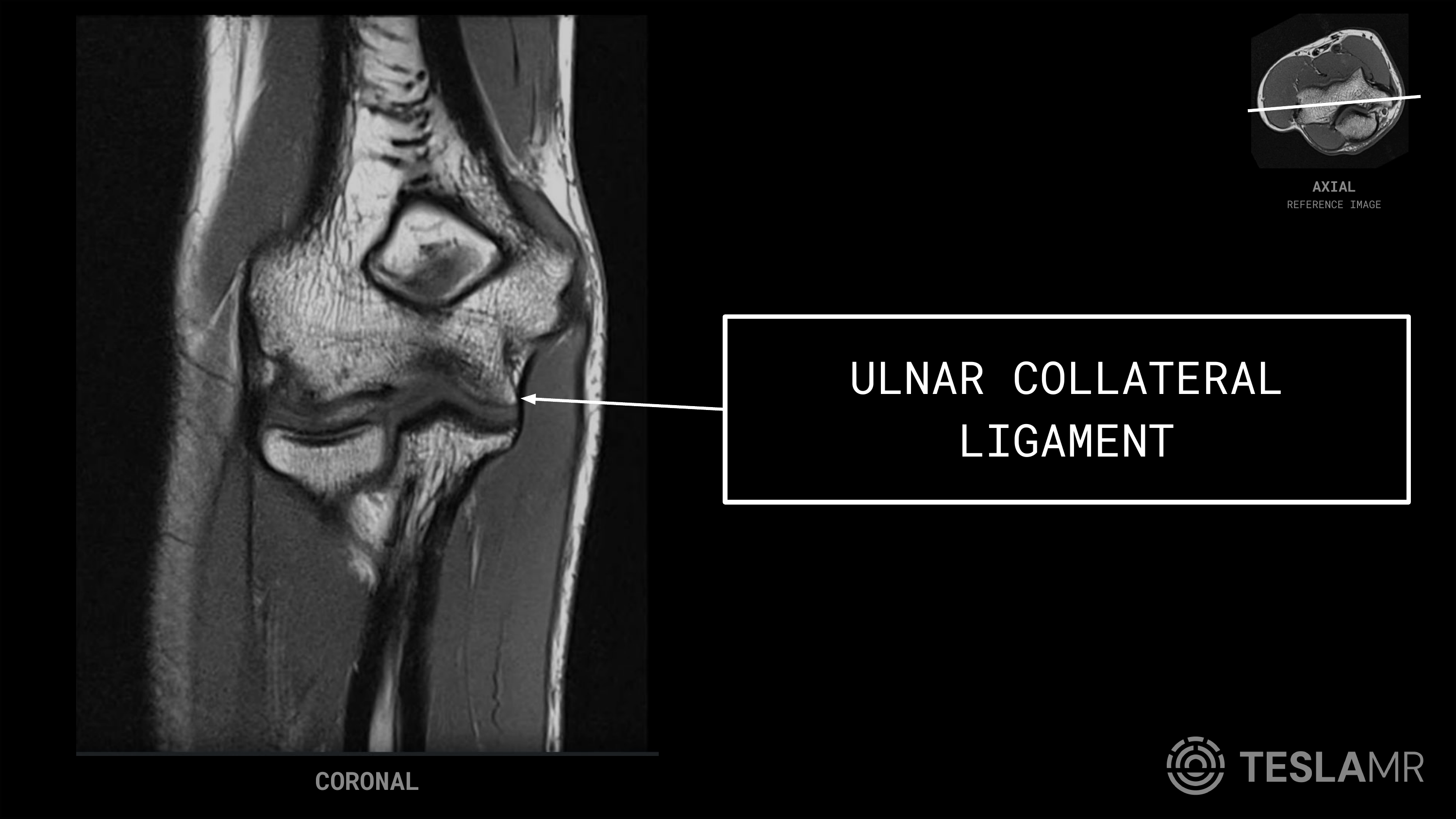 Ulnar Collateral Ligament labeled on a Elbow MRI (Coronal)